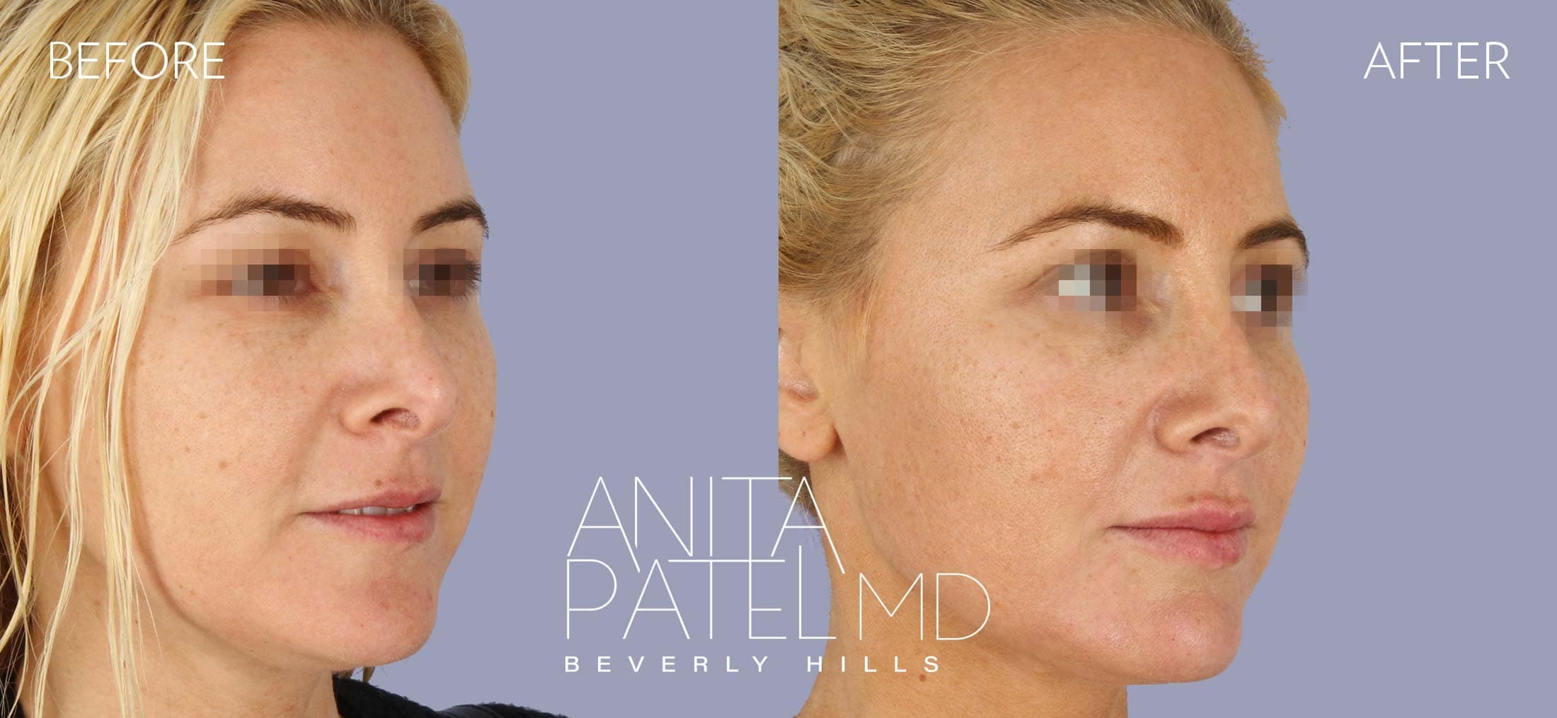 Venus RF Face before and after — Patient 4, photo 2 of 3 — Dr. Anita Patel, MD, FACS, Beverly Hills