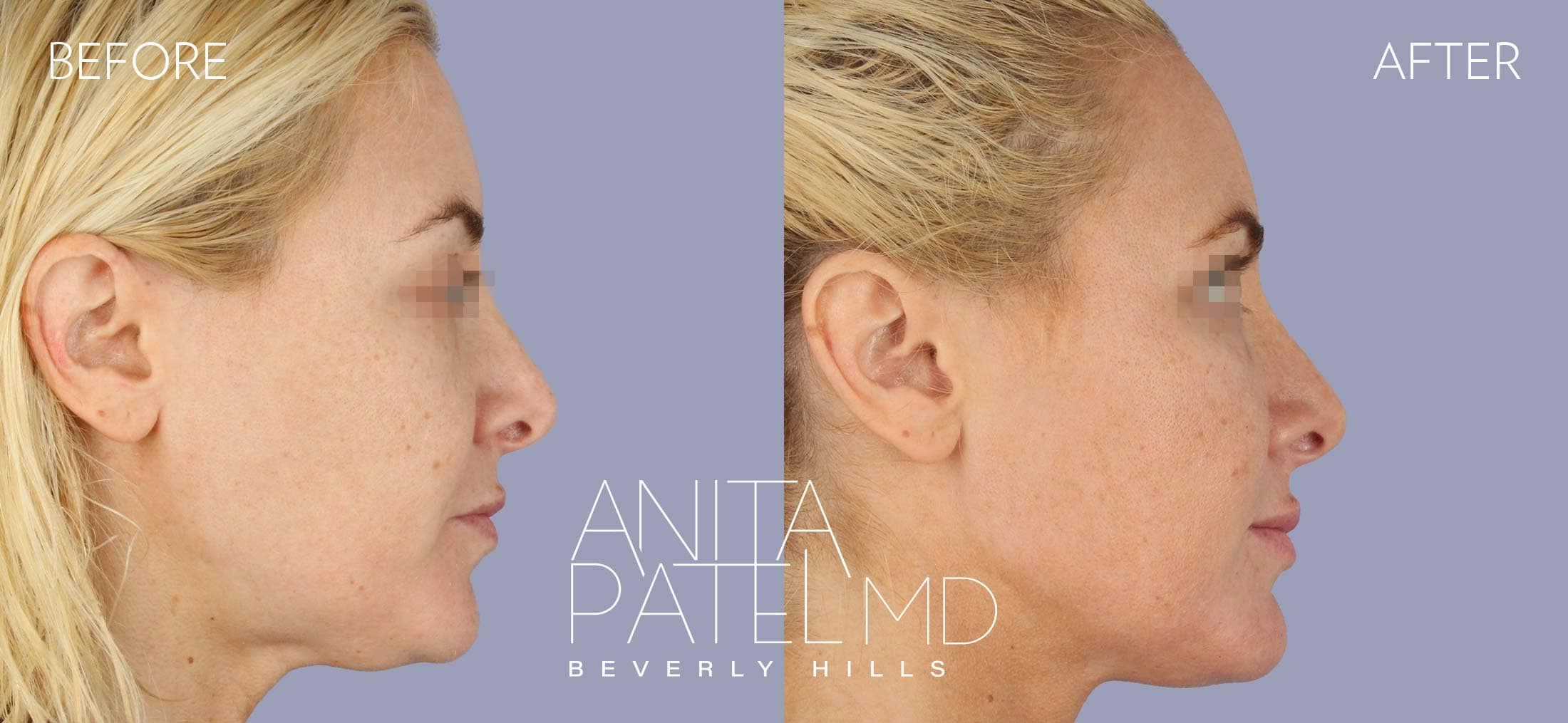 Venus RF Face before and after — Patient 4, photo 3 of 3 — Dr. Anita Patel, MD, FACS, Beverly Hills