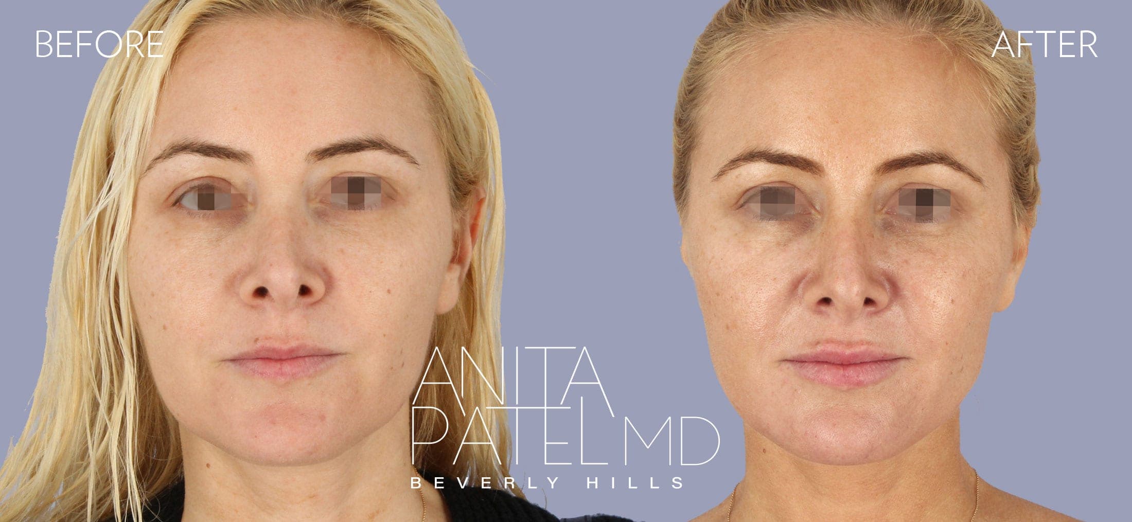 Venus RF Face before and after — Dr. Anita Patel, Beverly Hills