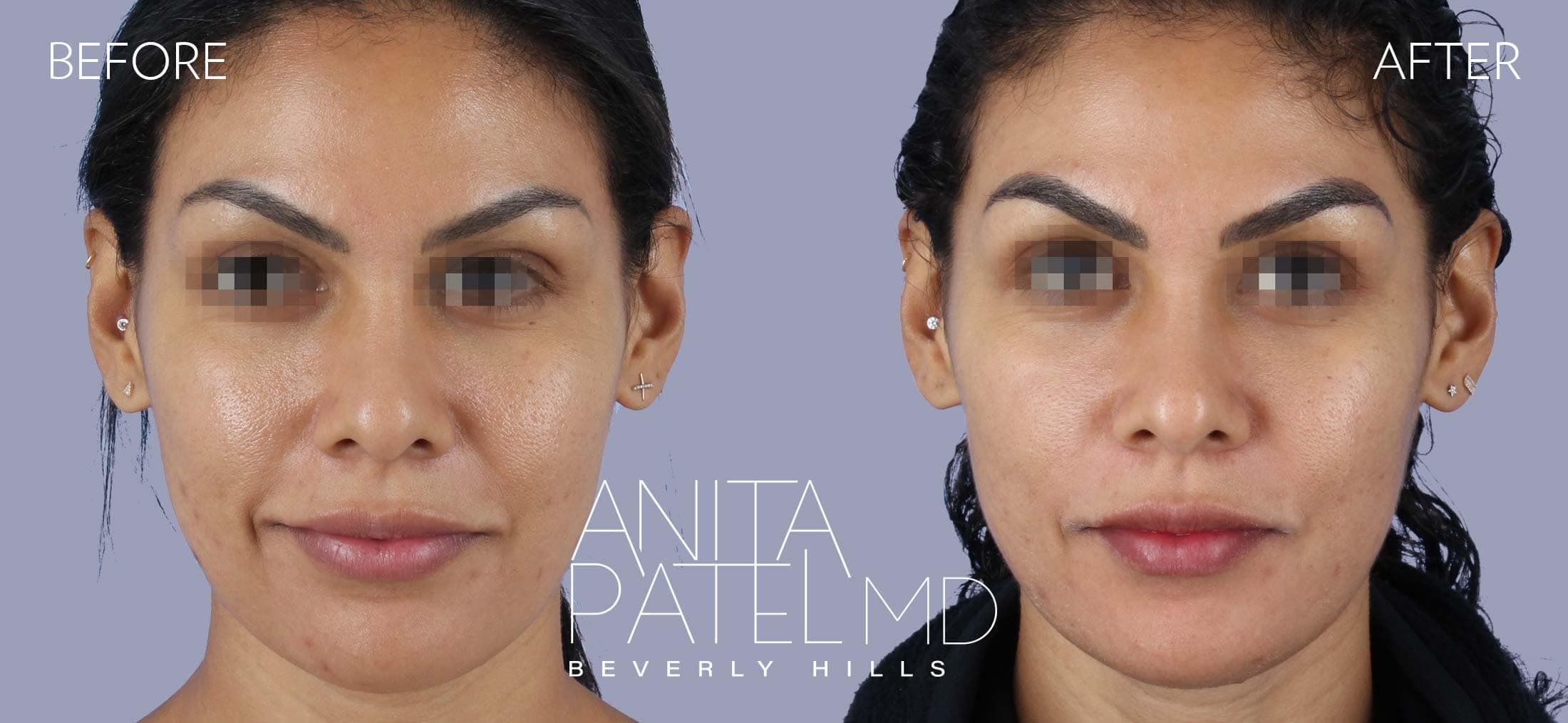 Venus RF Face before and after — Patient 5 — Dr. Anita Patel, MD, FACS, Beverly Hills
