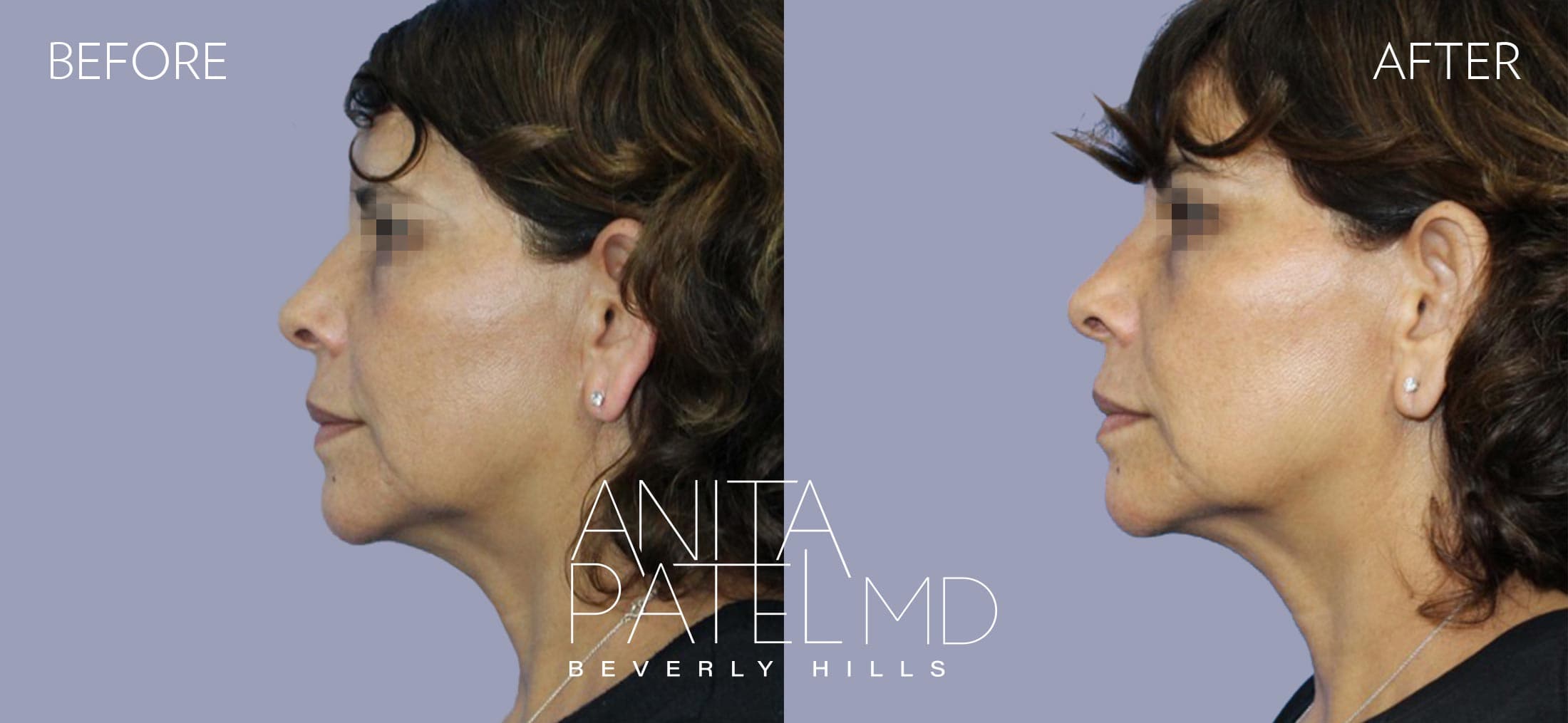 Venus RF Face before and after — Patient 7, photo 2 of 2 — Dr. Anita Patel, MD, FACS, Beverly Hills