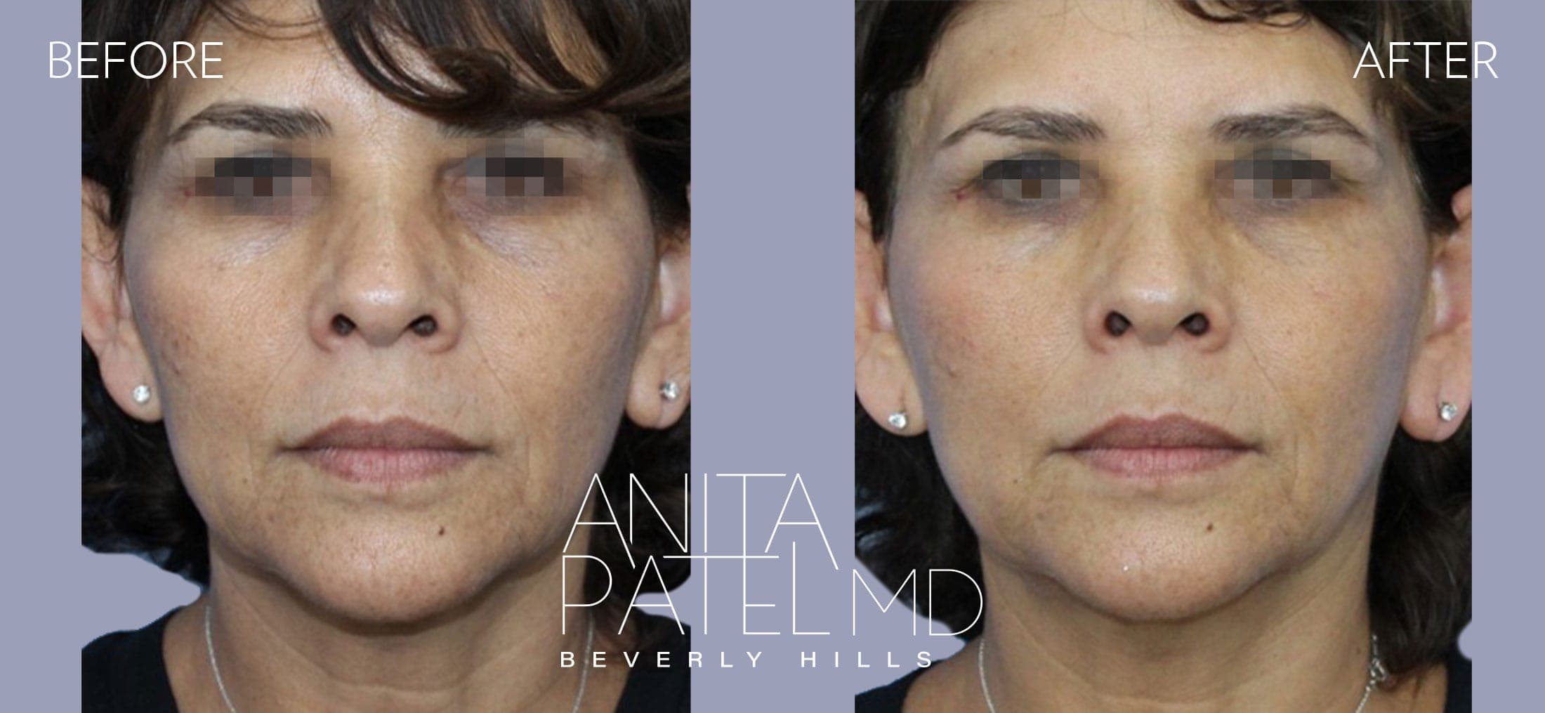 Venus RF Face before and after — Patient 7, photo 1 of 2 — Dr. Anita Patel, MD, FACS, Beverly Hills