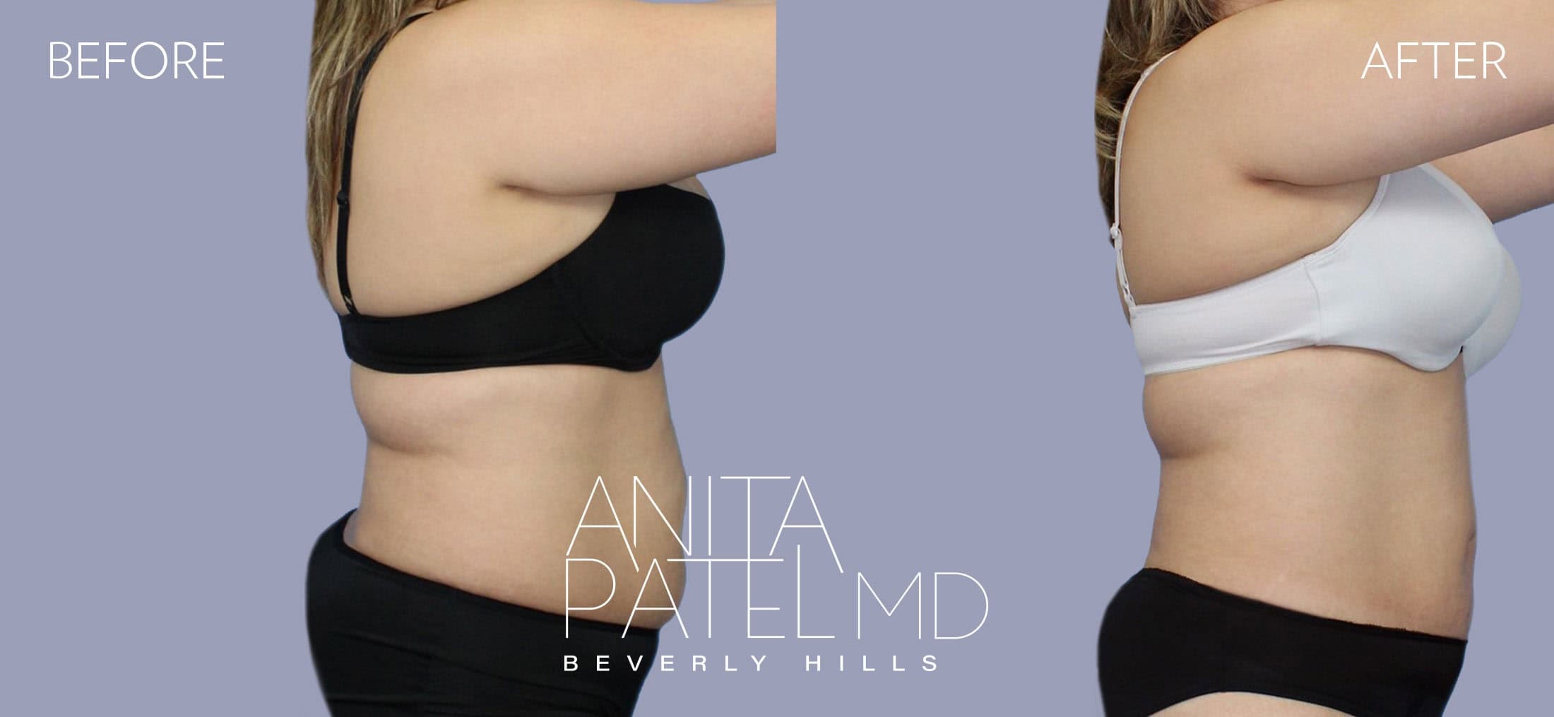 Venus RF Body before and after — Dr. Anita Patel, Beverly Hills