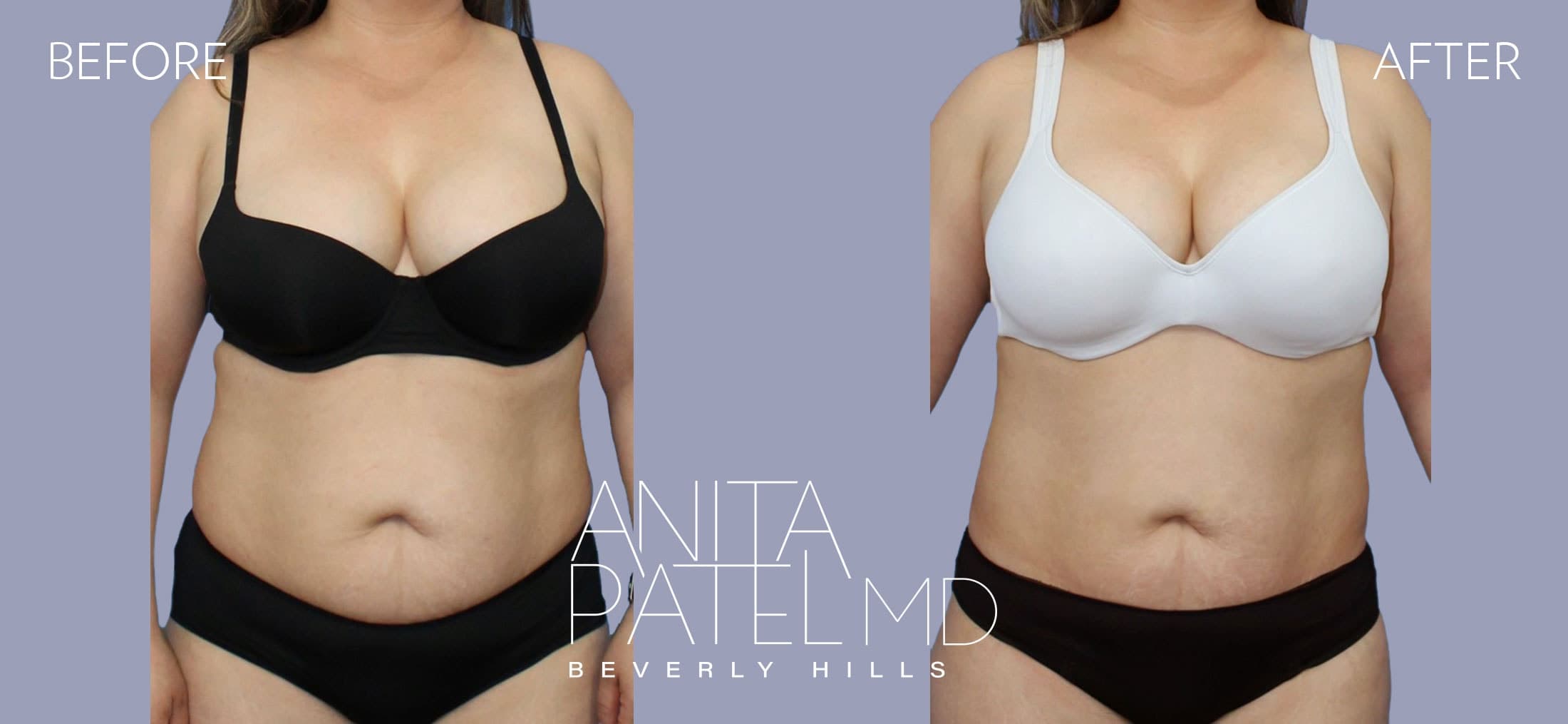 Venus RF Body before and after — Patient 2, photo 2 of 2 — Dr. Anita Patel, MD, FACS, Beverly Hills