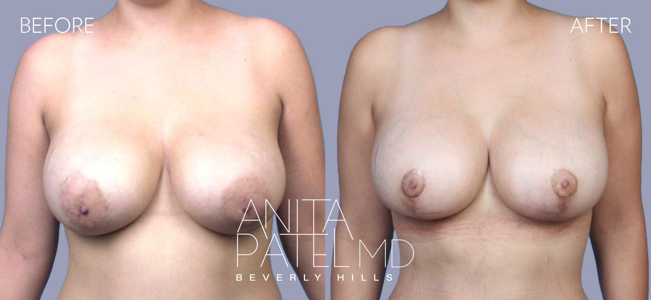 Breast Implant Replacement before and after — Patient 10, photo 1 of 4 — Dr. Anita Patel, MD, FACS, Beverly Hills