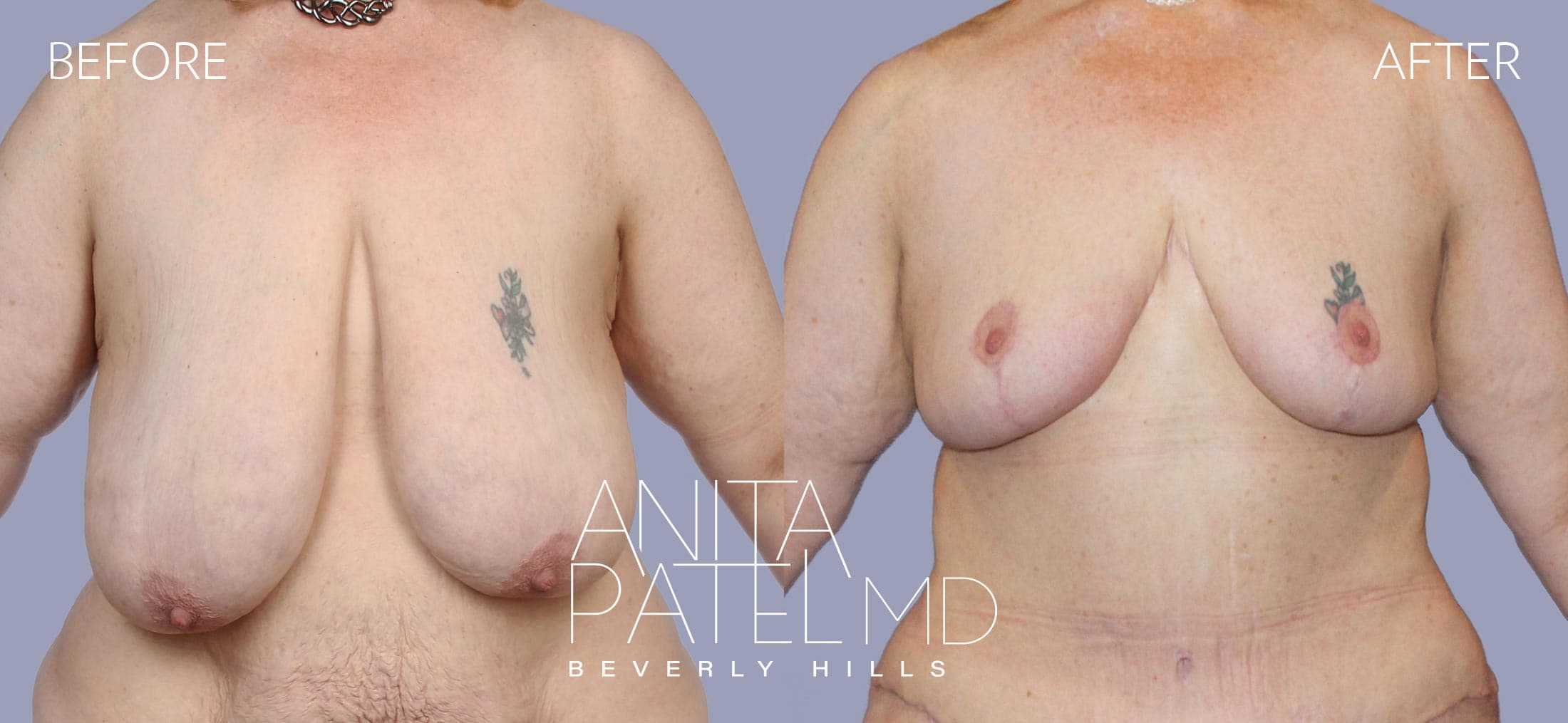 Breast Reduction before and after — Patient 11, photo 1 of 5 — Dr. Anita Patel, MD, FACS, Beverly Hills