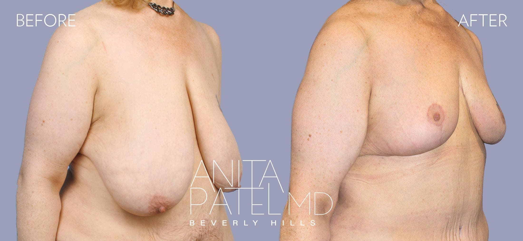 Breast Reduction before and after — Patient 11, photo 2 of 5 — Dr. Anita Patel, MD, FACS, Beverly Hills