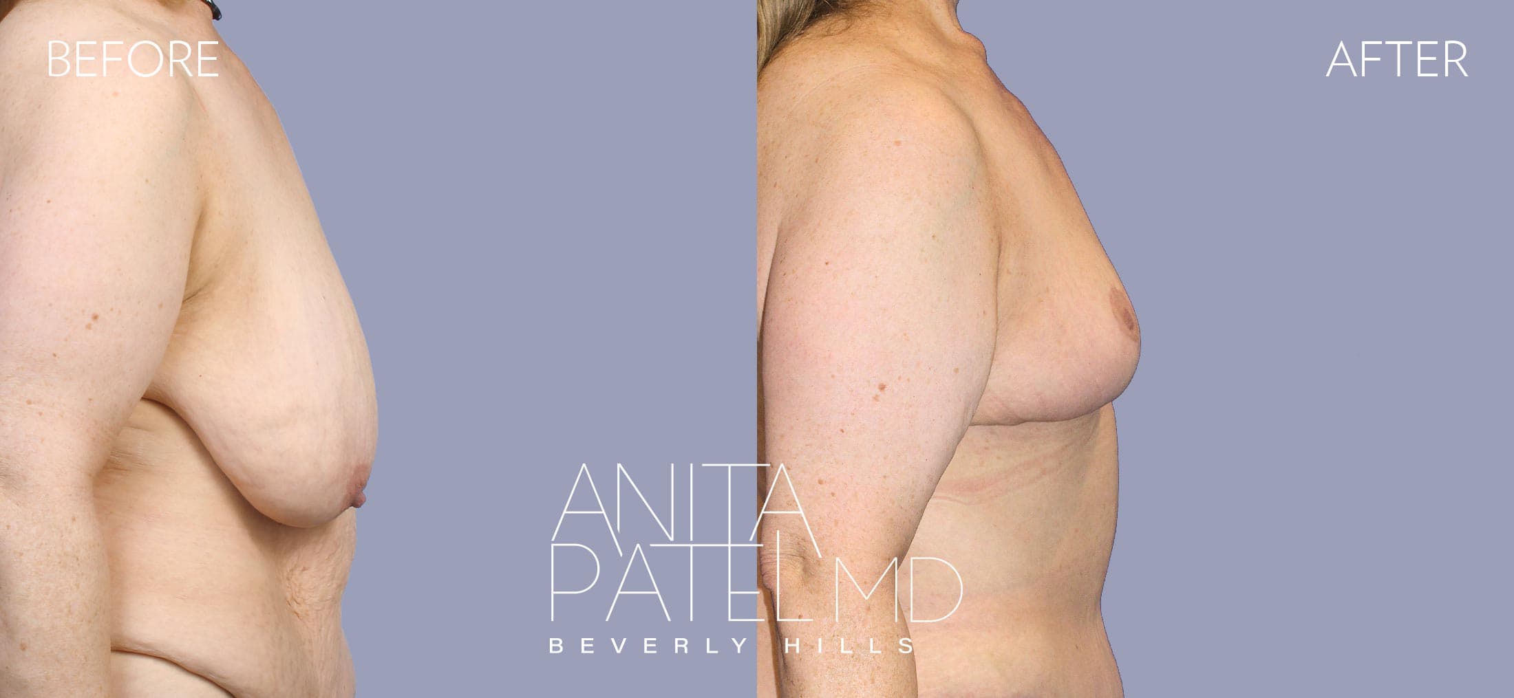 Breast Reduction before and after — Patient 11, photo 3 of 5 — Dr. Anita Patel, MD, FACS, Beverly Hills