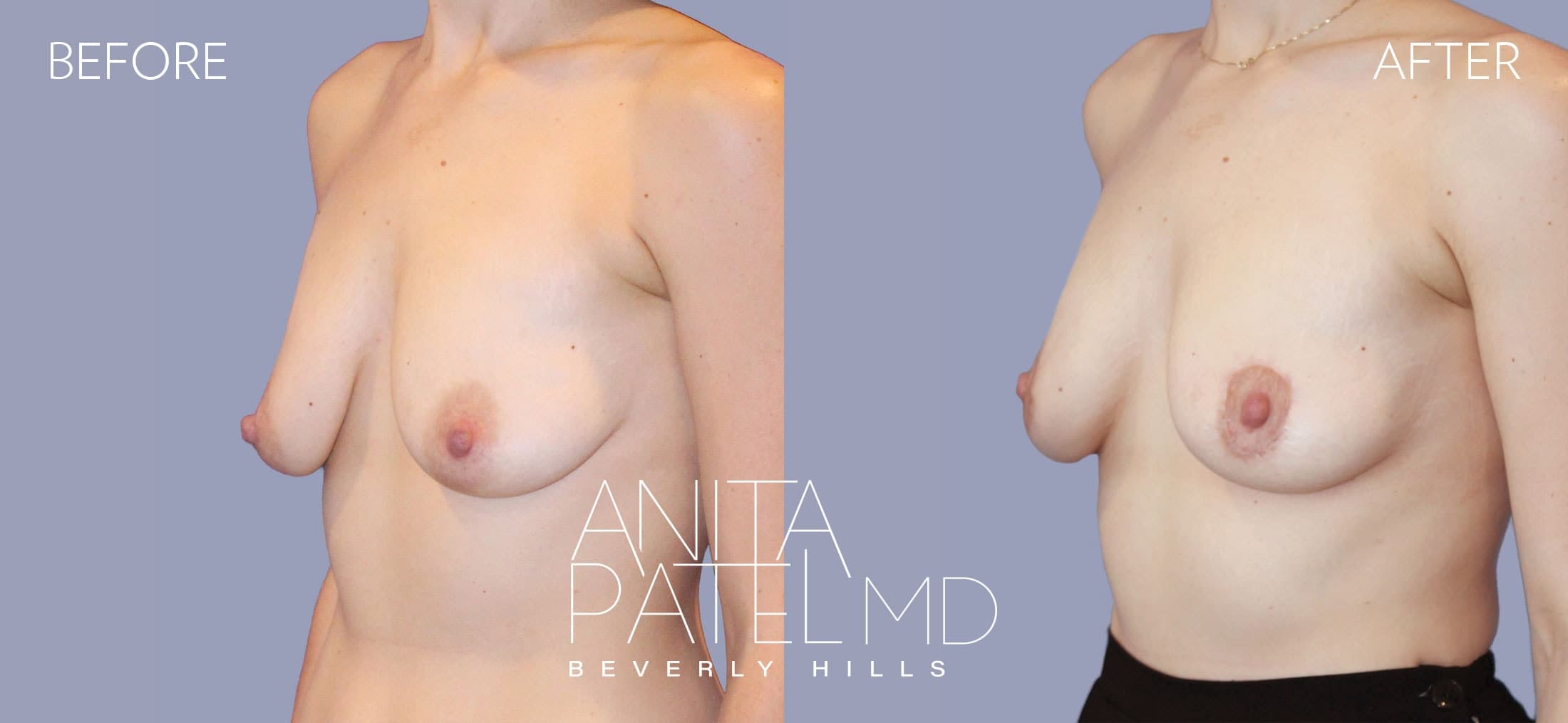 Breast Lift before and after — Patient 8, photo 4 of 5 — Dr. Anita Patel, MD, FACS, Beverly Hills