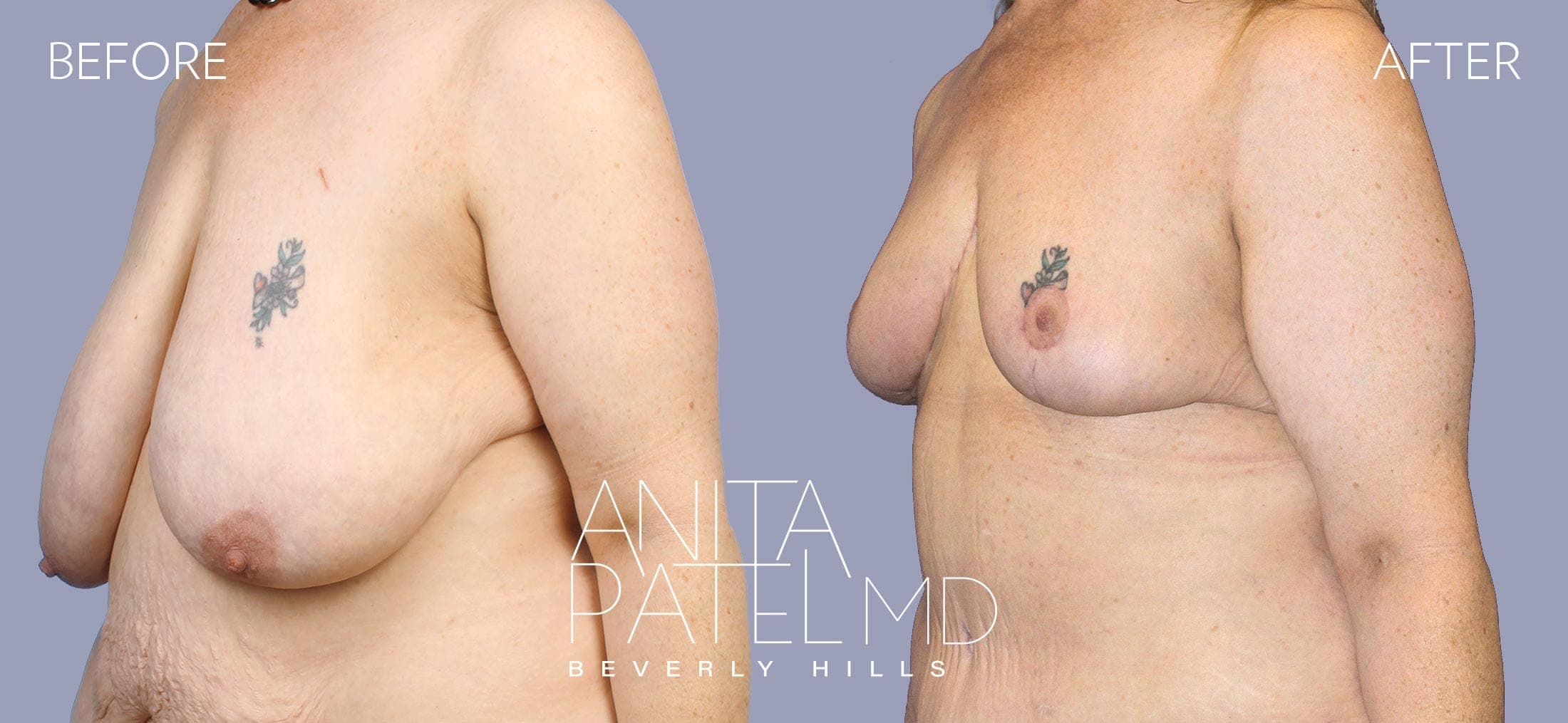 Breast Reduction before and after — Patient 11, photo 4 of 5 — Dr. Anita Patel, MD, FACS, Beverly Hills