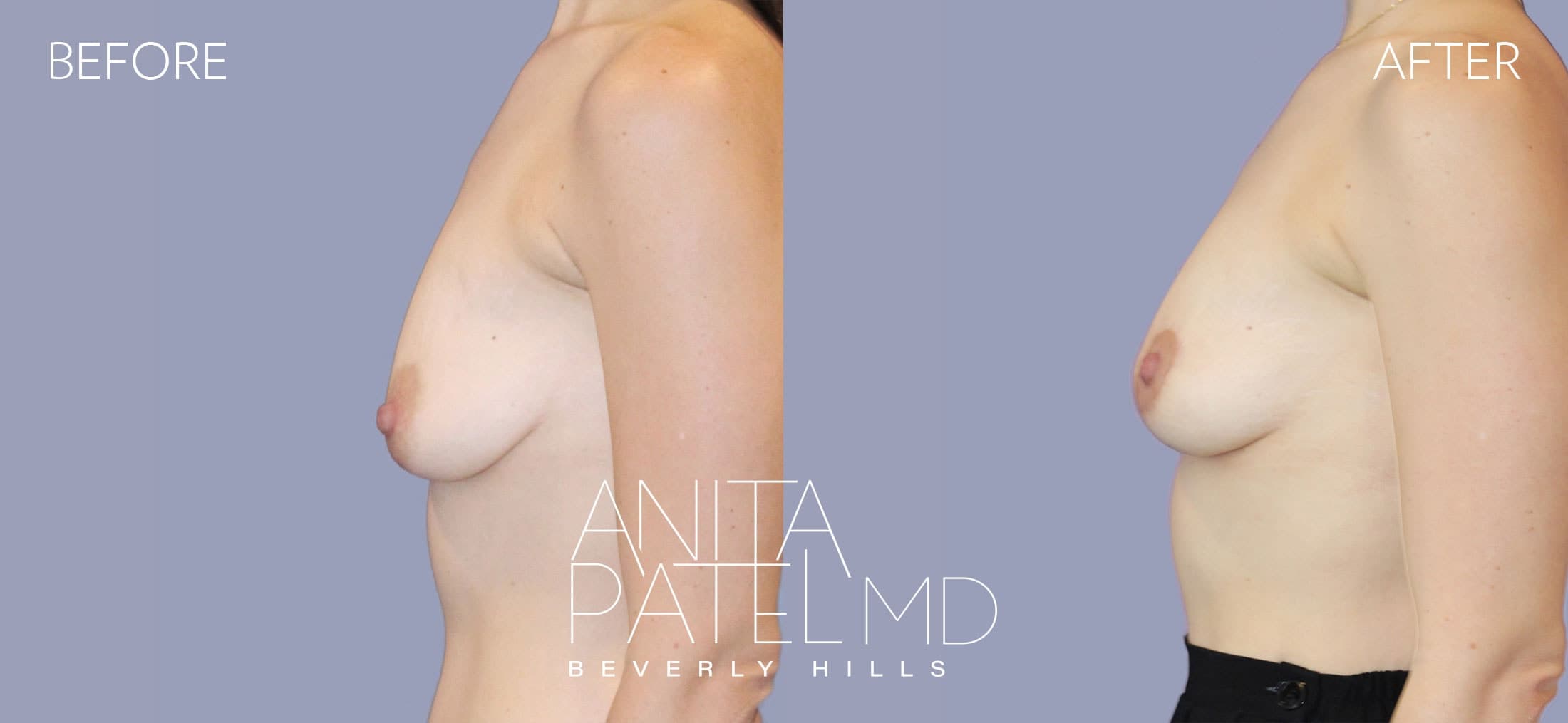 Breast Lift before and after — Patient 8, photo 5 of 5 — Dr. Anita Patel, MD, FACS, Beverly Hills