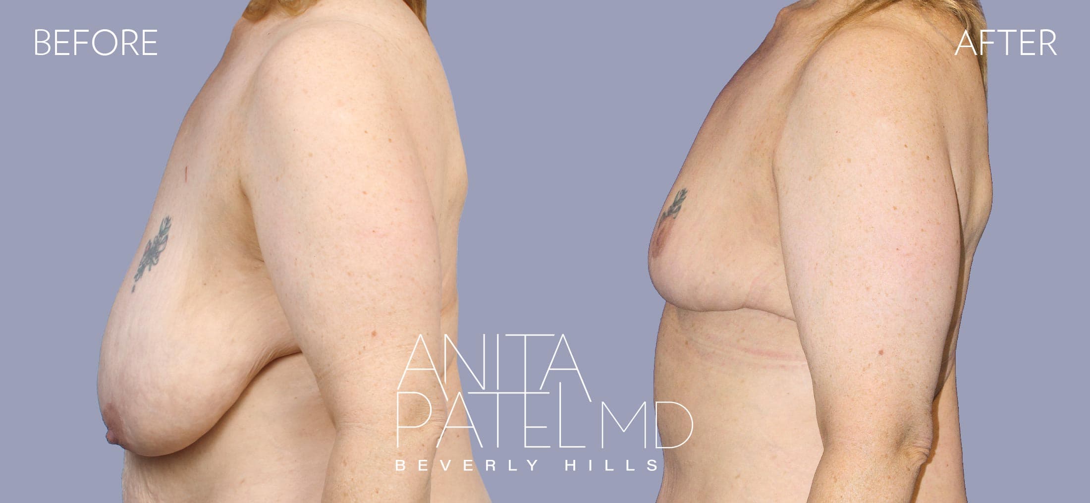 Breast Reduction before and after — Patient 11, photo 5 of 5 — Dr. Anita Patel, MD, FACS, Beverly Hills