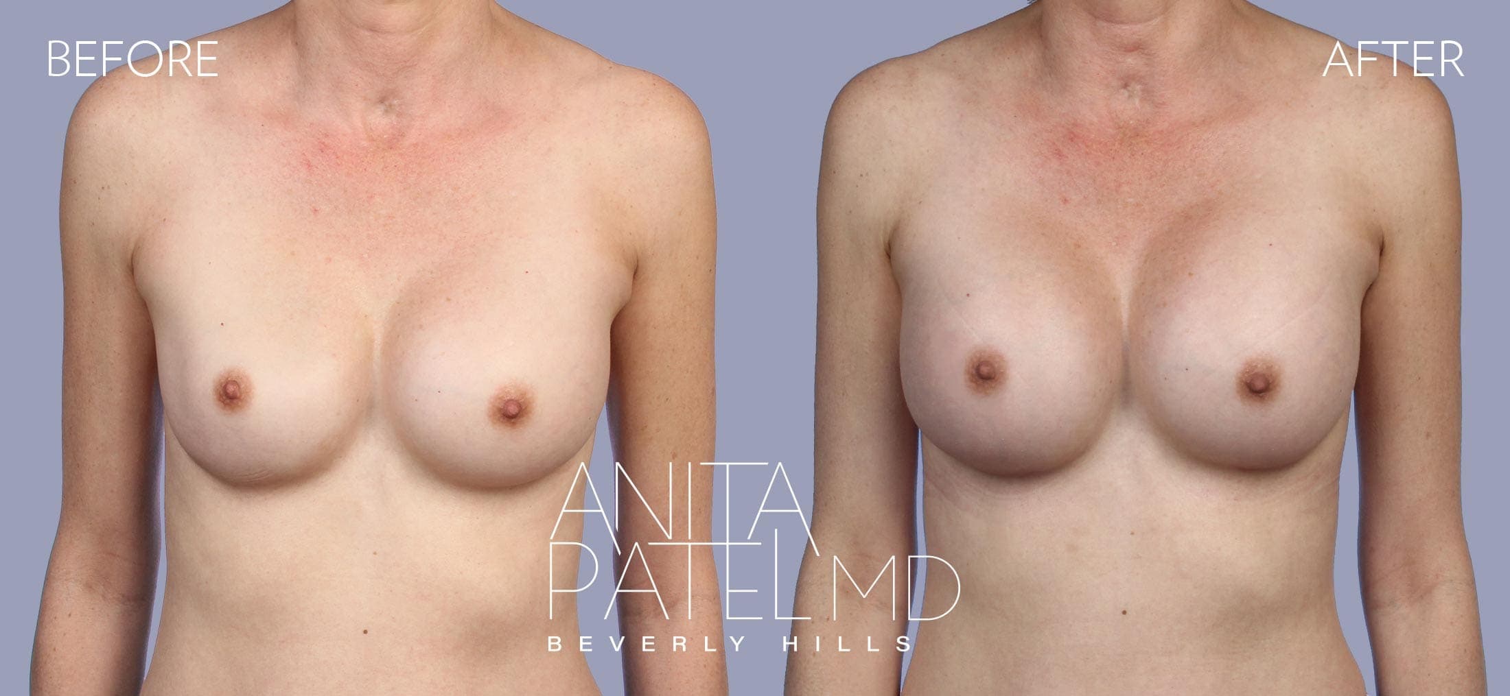 Breast Implant Replacement before and after — Patient 9, photo 1 of 3 — Dr. Anita Patel, MD, FACS, Beverly Hills