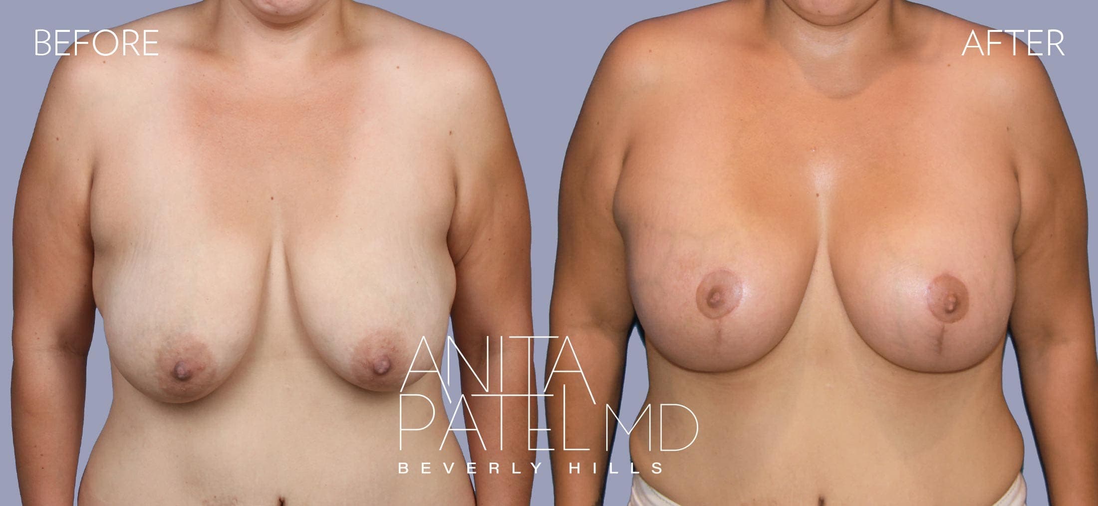 Breast Lift before and after — Patient 7, photo 1 of 5 — Dr. Anita Patel, MD, FACS, Beverly Hills