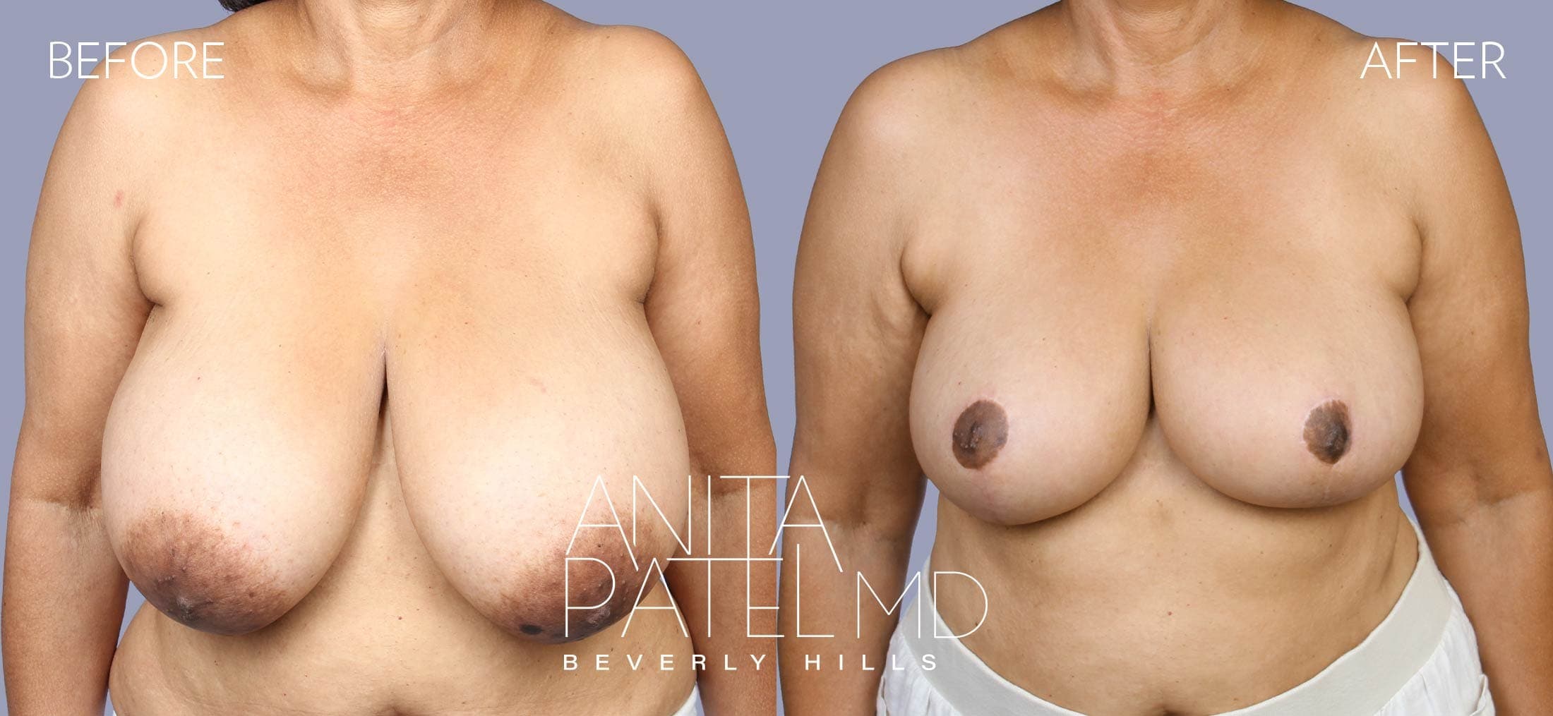 Breast Reduction before and after — Patient 2 — Dr. Anita Patel, MD, FACS, Beverly Hills