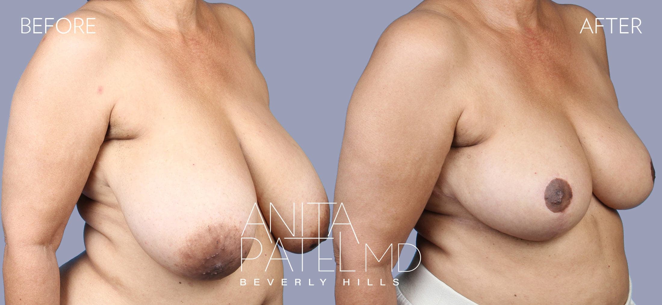 Breast Reduction before and after — Patient 10, photo 2 of 5 — Dr. Anita Patel, MD, FACS, Beverly Hills