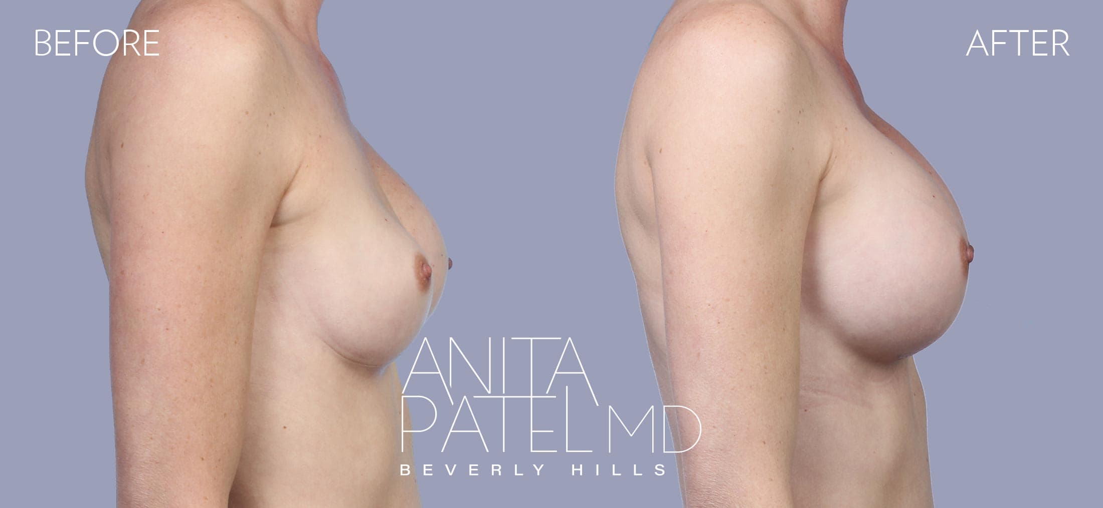 Breast Implant Replacement before and after — Patient 9, photo 3 of 3 — Dr. Anita Patel, MD, FACS, Beverly Hills