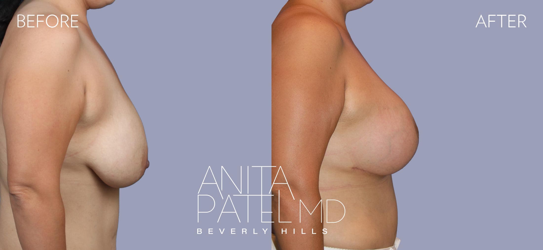 Breast Lift before and after — Patient 7, photo 3 of 5 — Dr. Anita Patel, MD, FACS, Beverly Hills
