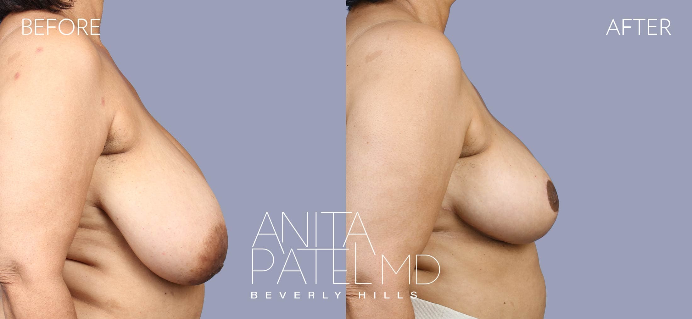 Breast Reduction before and after — Patient 10, photo 3 of 5 — Dr. Anita Patel, MD, FACS, Beverly Hills