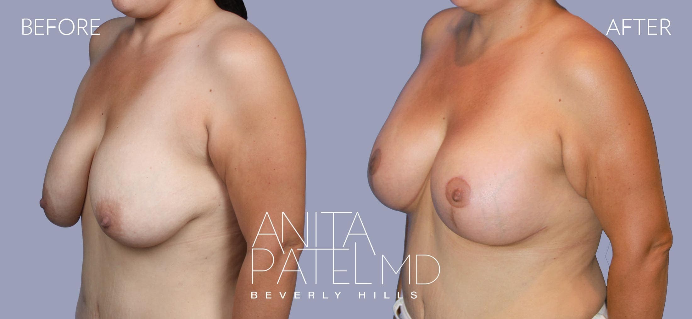Breast Lift before and after — Patient 7, photo 4 of 5 — Dr. Anita Patel, MD, FACS, Beverly Hills