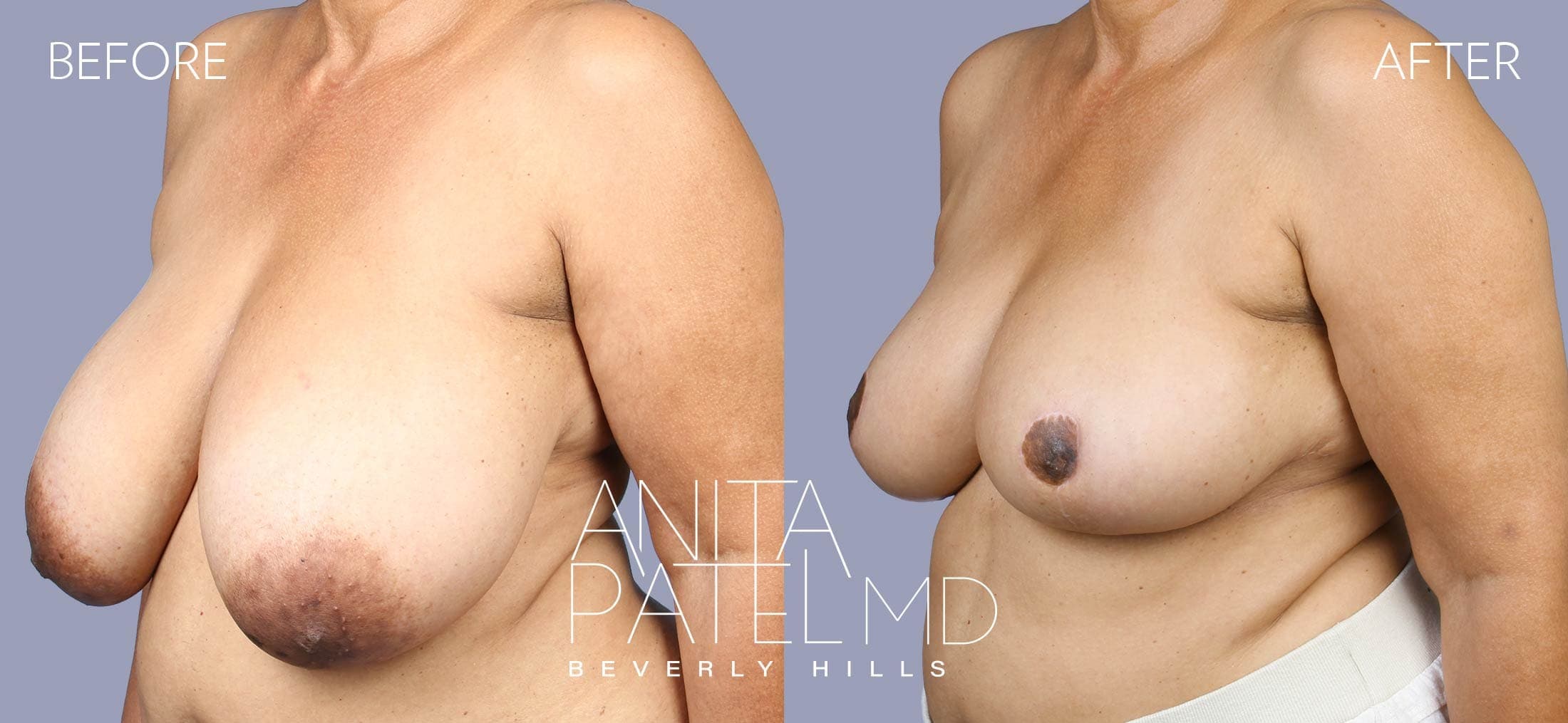 Breast Reduction before and after — Patient 10, photo 4 of 5 — Dr. Anita Patel, MD, FACS, Beverly Hills