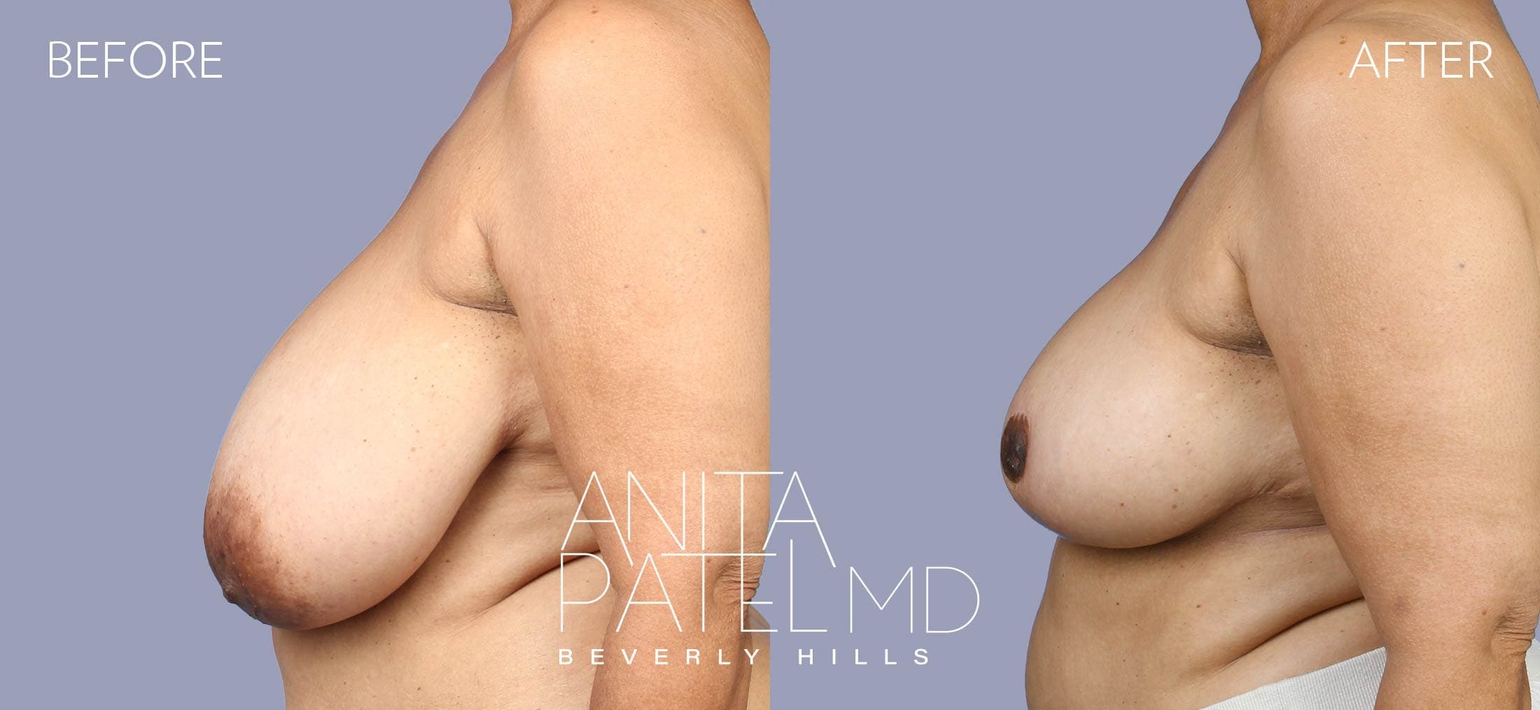 Breast Reduction before and after — Patient 10, photo 5 of 5 — Dr. Anita Patel, MD, FACS, Beverly Hills