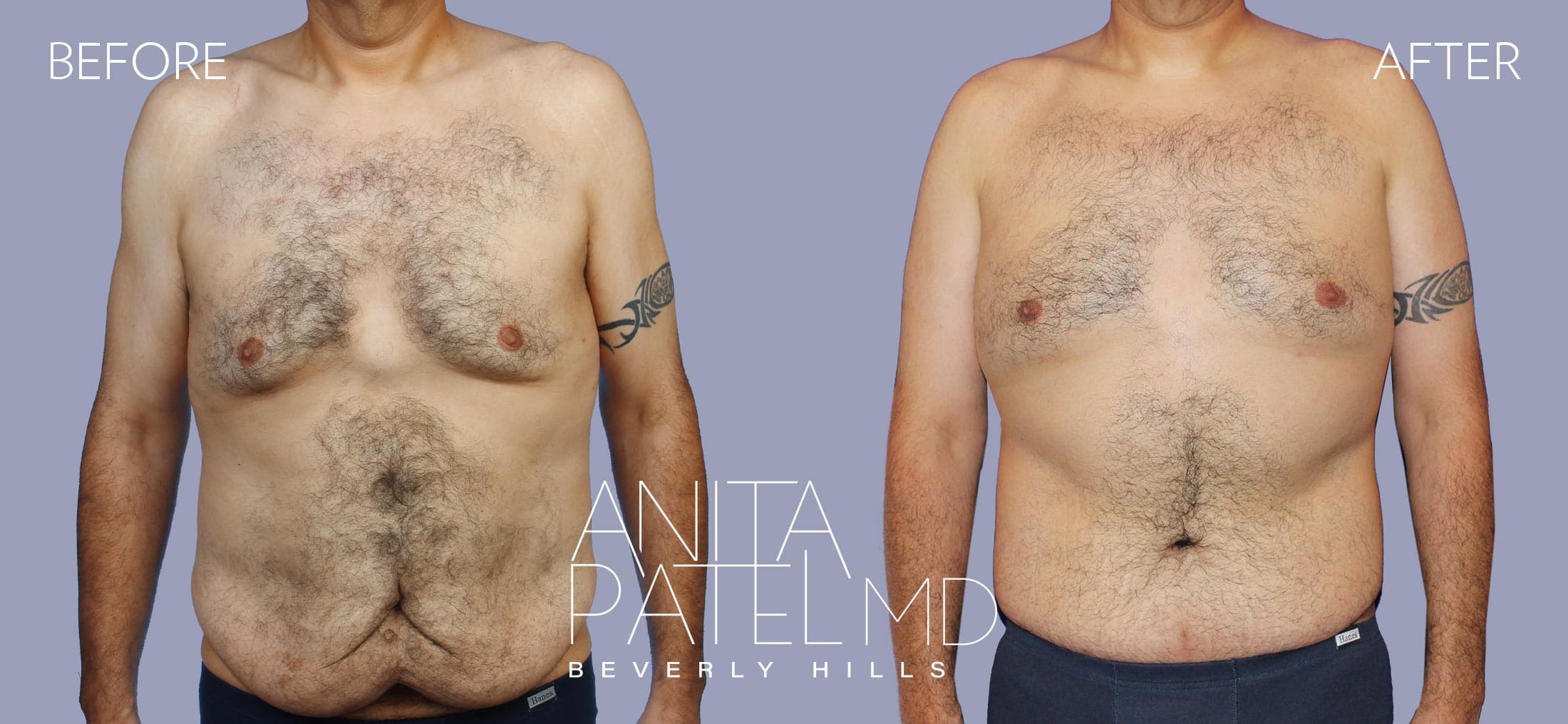 Gynecomastia before and after — Patient 1 — Dr. Anita Patel, MD, FACS, Beverly Hills