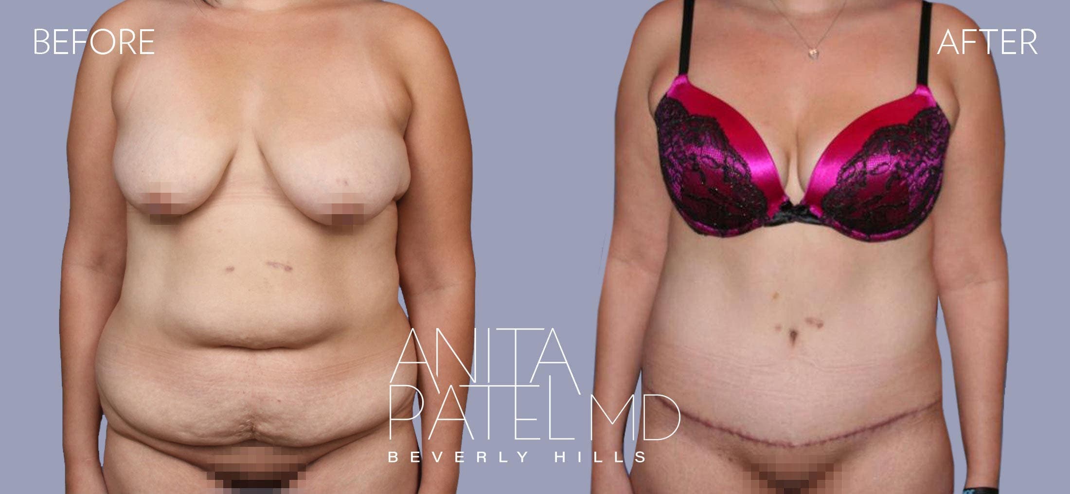 Tummy Tuck before and after — Patient 20 — Dr. Anita Patel, MD, FACS, Beverly Hills