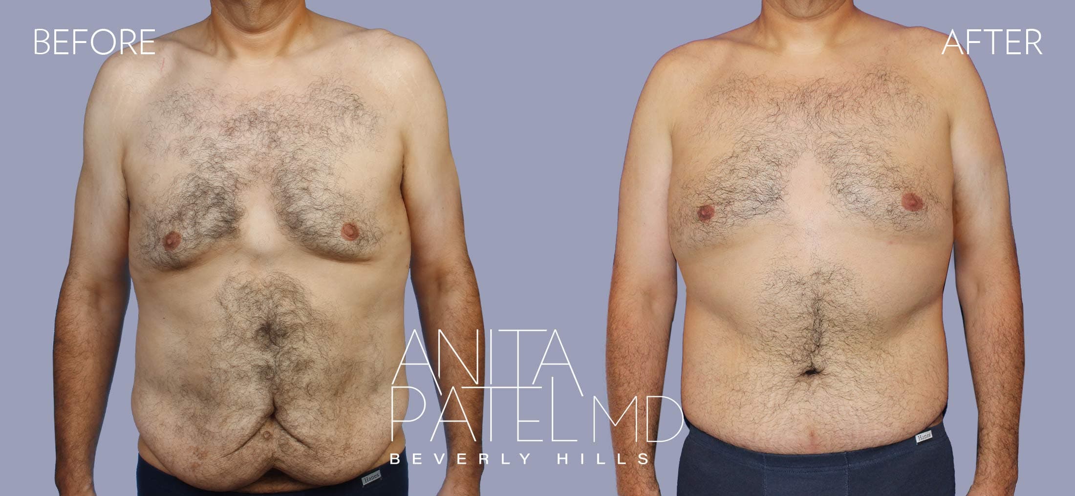 Tummy Tuck before and after — Patient 22 — Dr. Anita Patel, MD, FACS, Beverly Hills