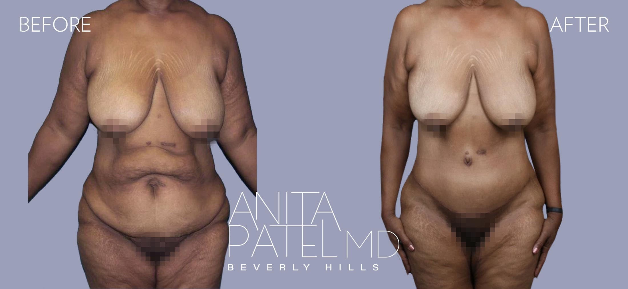 Tummy Tuck before and after — Patient 21 — Dr. Anita Patel, MD, FACS, Beverly Hills