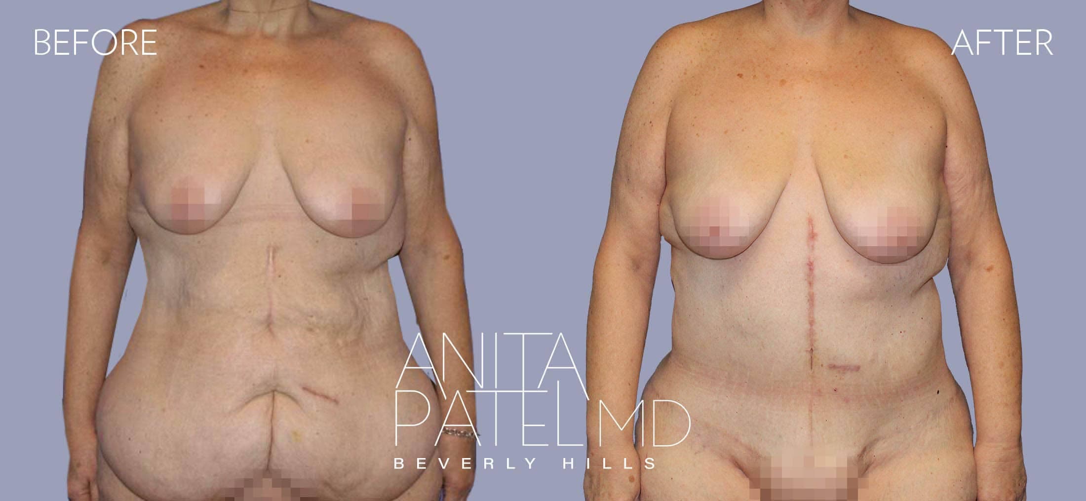 Tummy Tuck before and after — Patient 18 — Dr. Anita Patel, MD, FACS, Beverly Hills