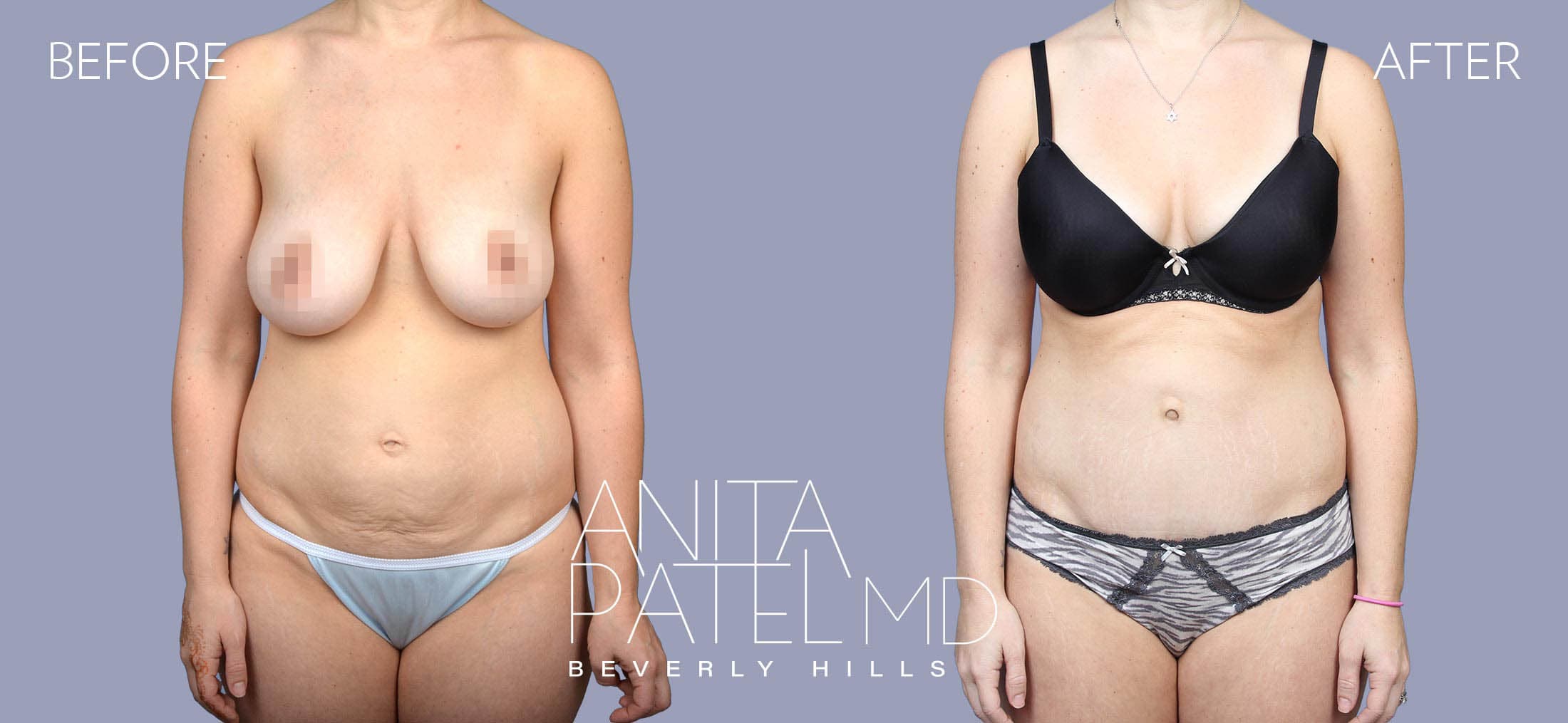 Tummy Tuck before and after — Patient 25 — Dr. Anita Patel, MD, FACS, Beverly Hills