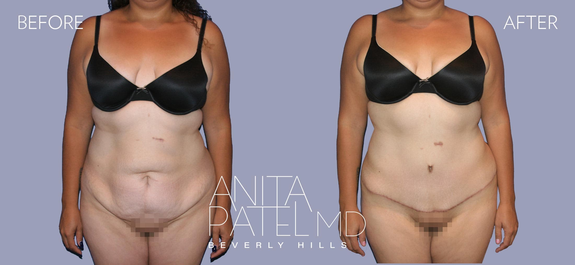 Tummy Tuck before and after — Patient 26 — Dr. Anita Patel, MD, FACS, Beverly Hills