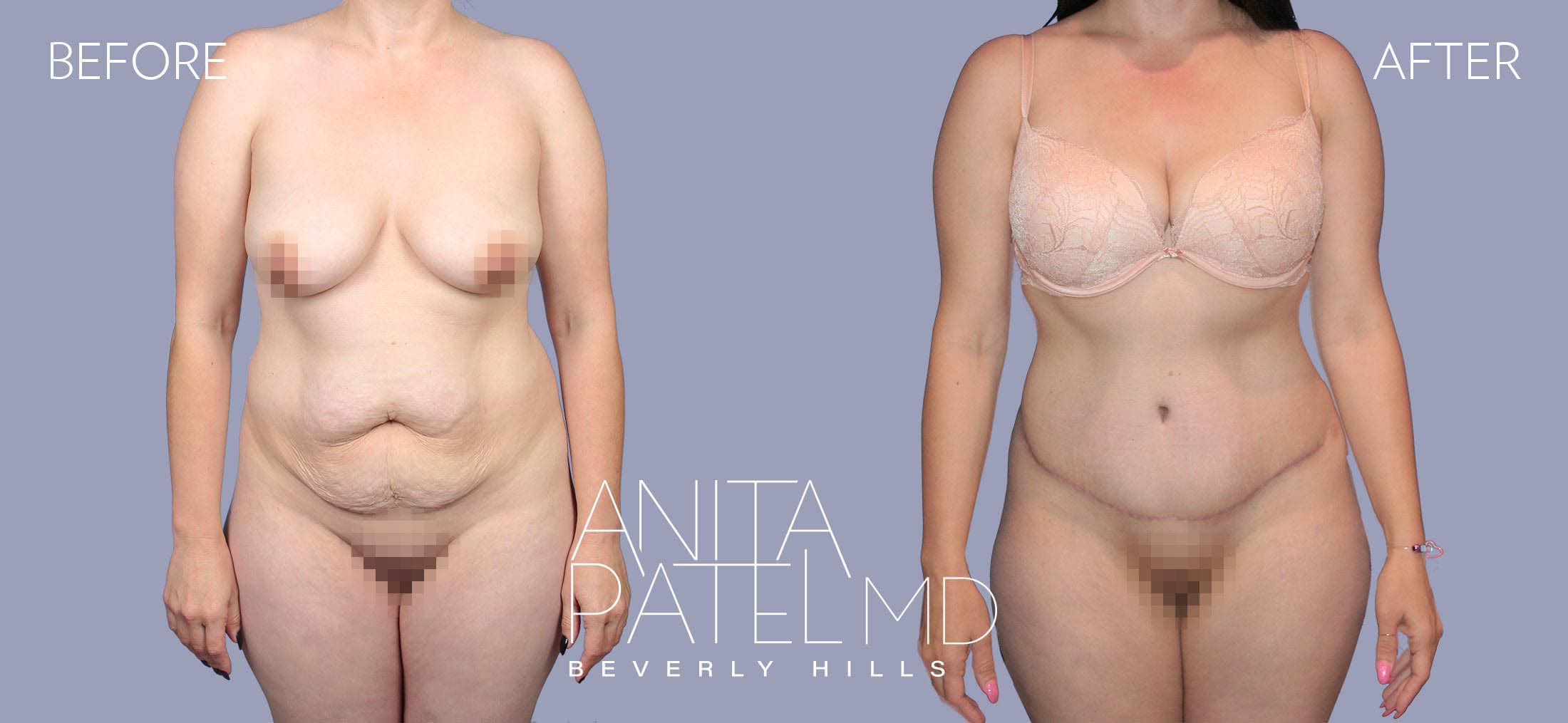 Tummy Tuck before and after — Patient 28 — Dr. Anita Patel, MD, FACS, Beverly Hills