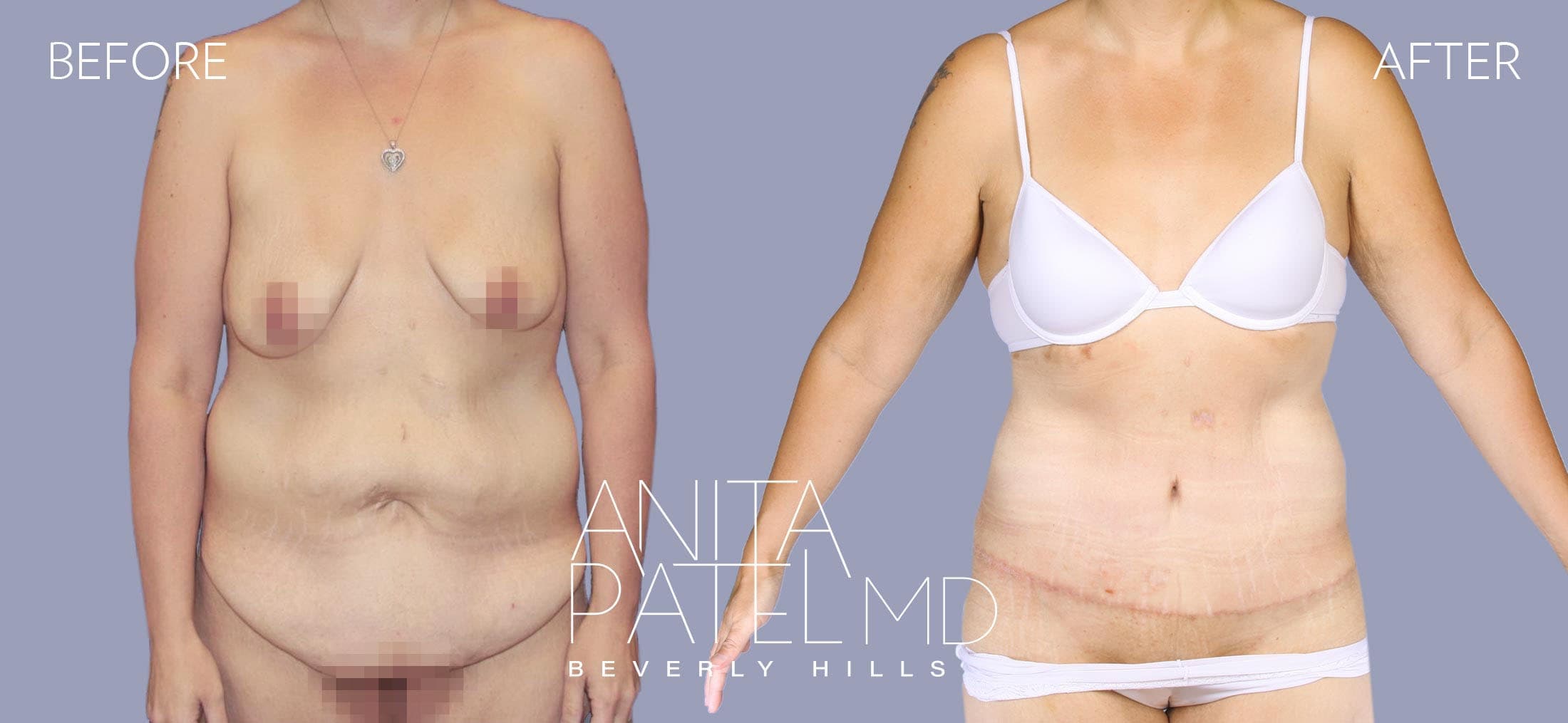 Tummy Tuck before and after — Patient 7, photo 1 of 2 — Dr. Anita Patel, MD, FACS, Beverly Hills