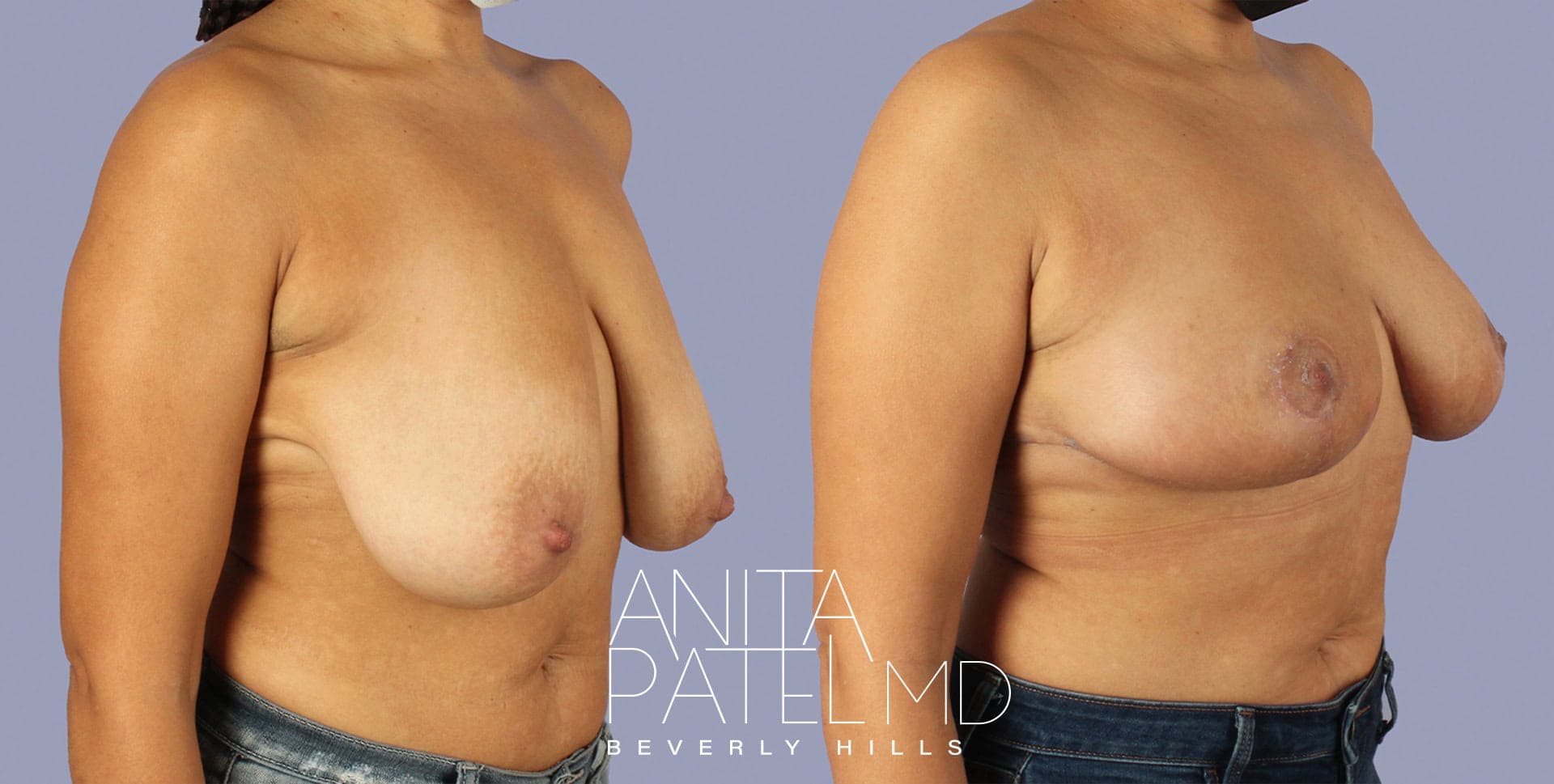 Breast Lift before and after — Patient 1, photo 1 of 3 — Dr. Anita Patel, MD, FACS, Beverly Hills