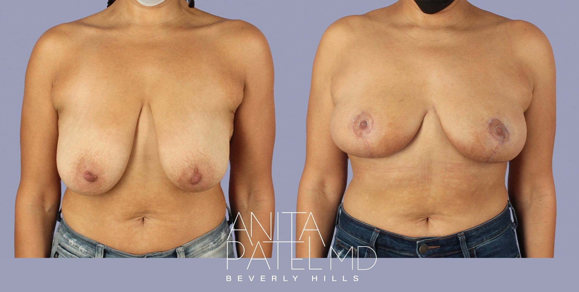 Breast Lift before and after — Patient 1, photo 2 of 3 — Dr. Anita Patel, MD, FACS, Beverly Hills