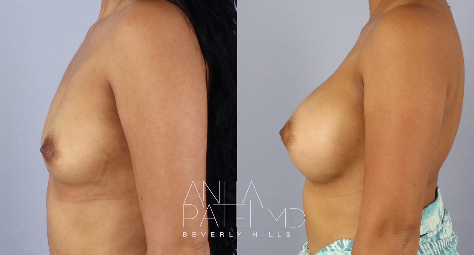 Breast Augmentation before and after — Patient 13 — Dr. Anita Patel, MD, FACS, Beverly Hills