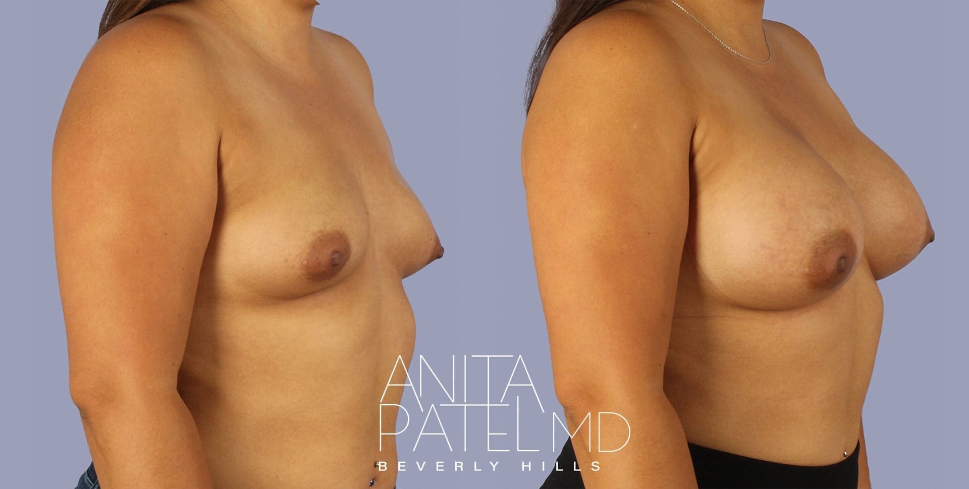 Breast Augmentation before and after — Patient 12, photo 1 of 2 — Dr. Anita Patel, MD, FACS, Beverly Hills