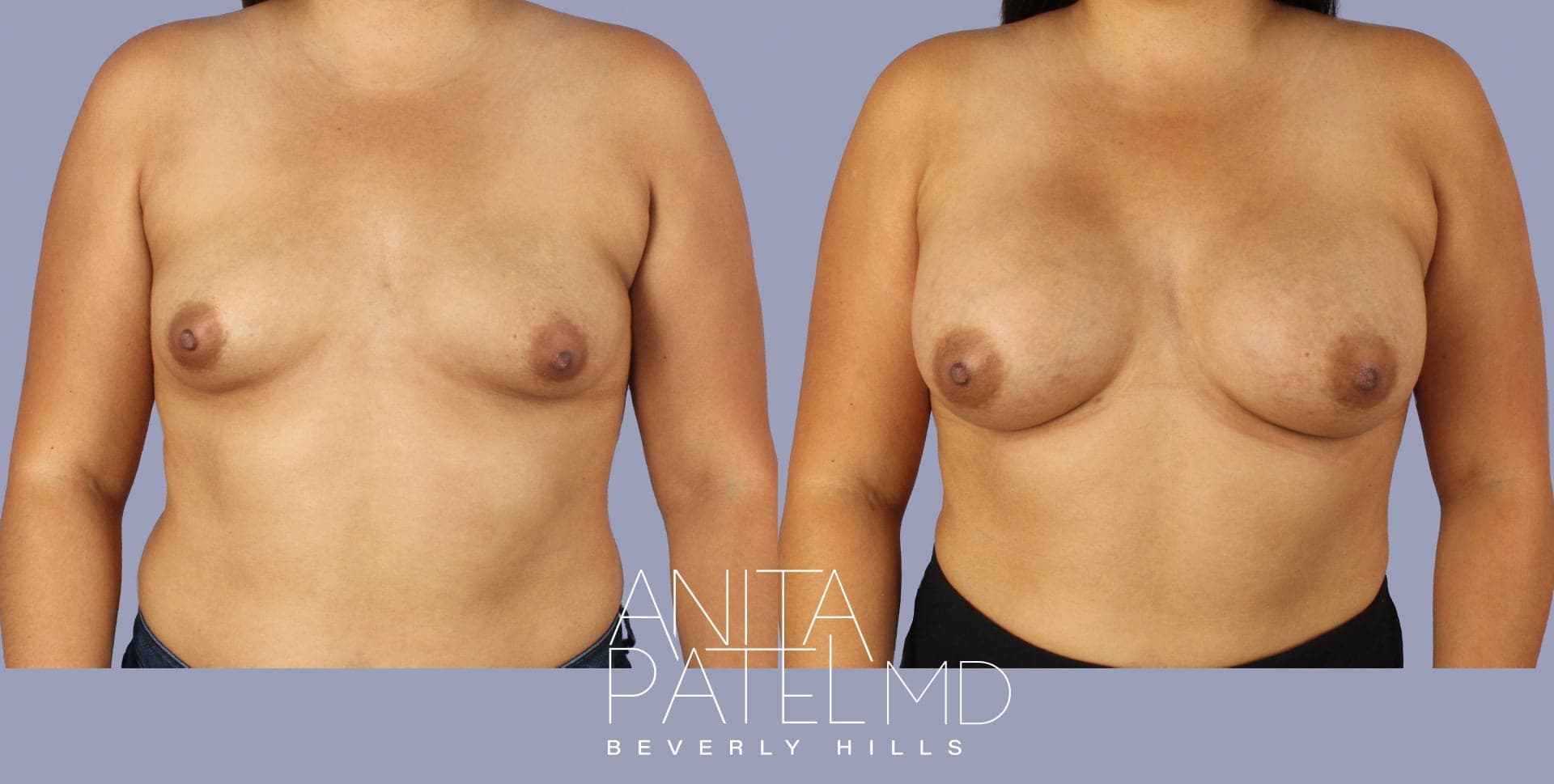 Breast Augmentation before and after — Patient 12, photo 2 of 2 — Dr. Anita Patel, MD, FACS, Beverly Hills