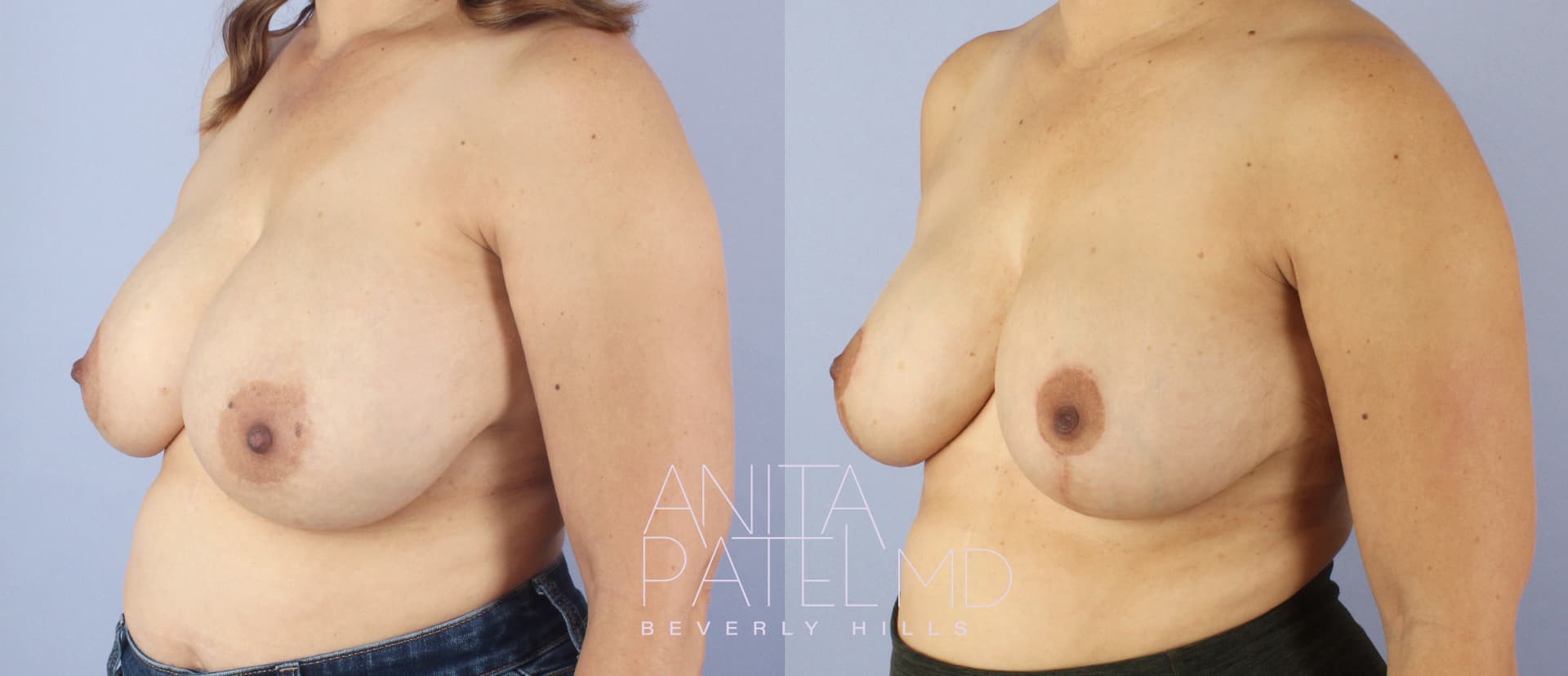 Breast Reduction before and after — Patient 6 — Dr. Anita Patel, MD, FACS, Beverly Hills