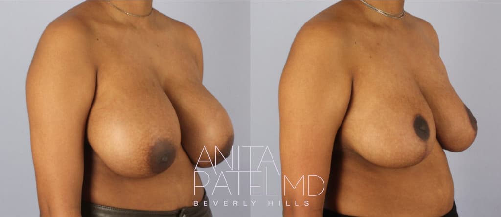Breast Reduction before and after — Patient 7 — Dr. Anita Patel, MD, FACS, Beverly Hills