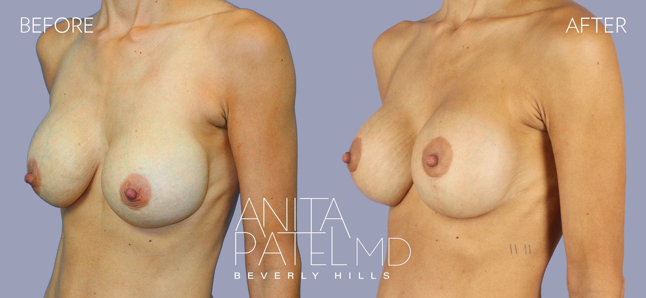 Breast Implant Revision before and after — Patient 4, photo 3 of 3 — Dr. Anita Patel, MD, FACS, Beverly Hills