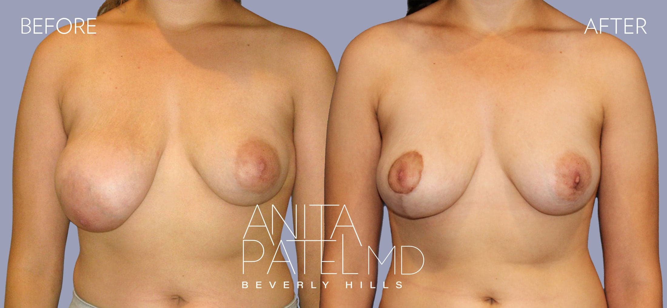 Breast Reduction before and after — Patient 9, photo 1 of 4 — Dr. Anita Patel, MD, FACS, Beverly Hills