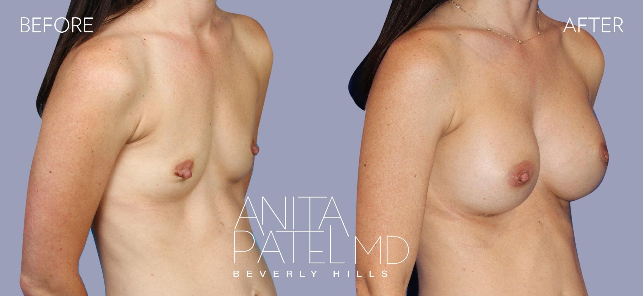 Breast Augmentation before and after — Patient 14, photo 2 of 5 — Dr. Anita Patel, MD, FACS, Beverly Hills