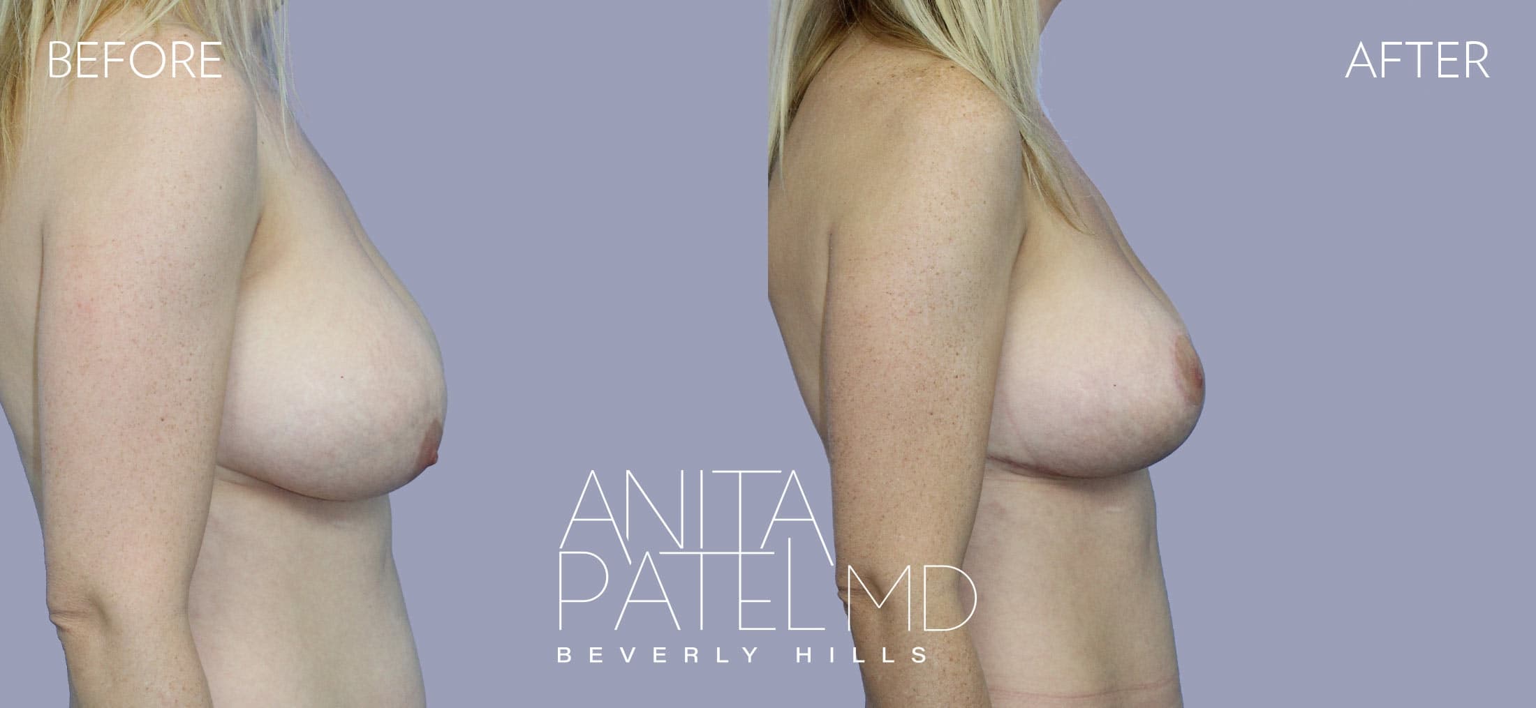Breast Implant Replacement before and after — Patient 8, photo 3 of 3 — Dr. Anita Patel, MD, FACS, Beverly Hills