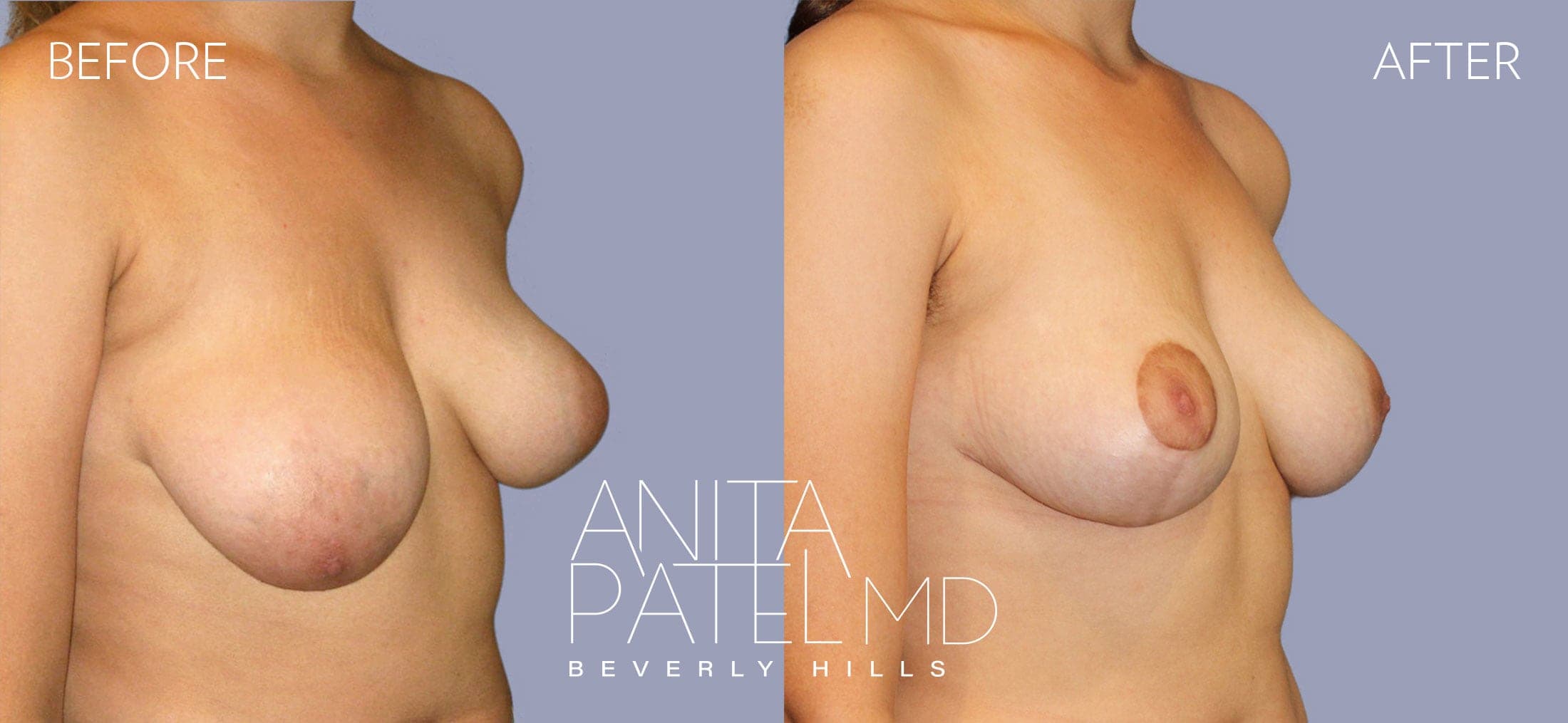 Breast Reduction before and after — Patient 9, photo 3 of 4 — Dr. Anita Patel, MD, FACS, Beverly Hills