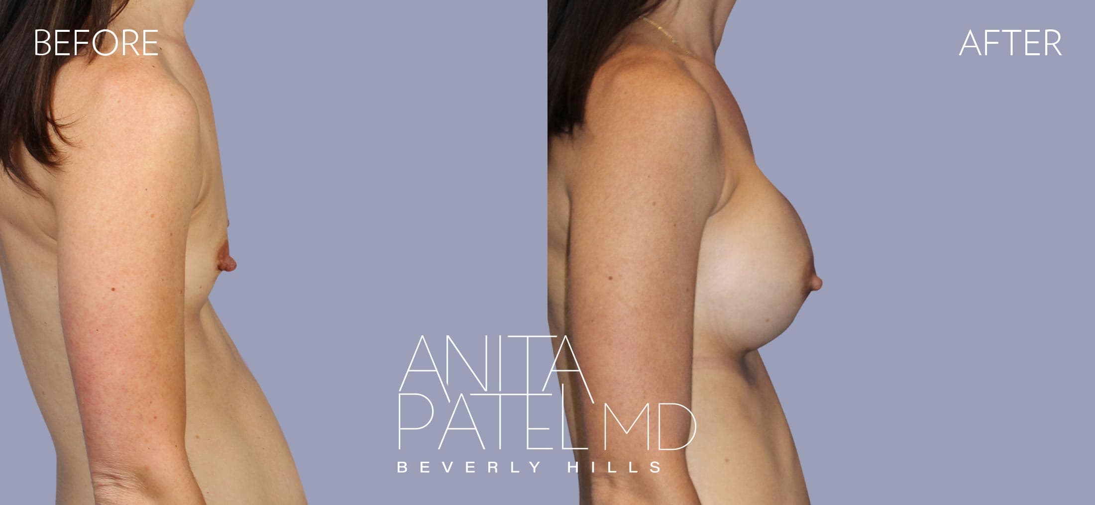 Breast Augmentation before and after — Patient 14, photo 3 of 5 — Dr. Anita Patel, MD, FACS, Beverly Hills