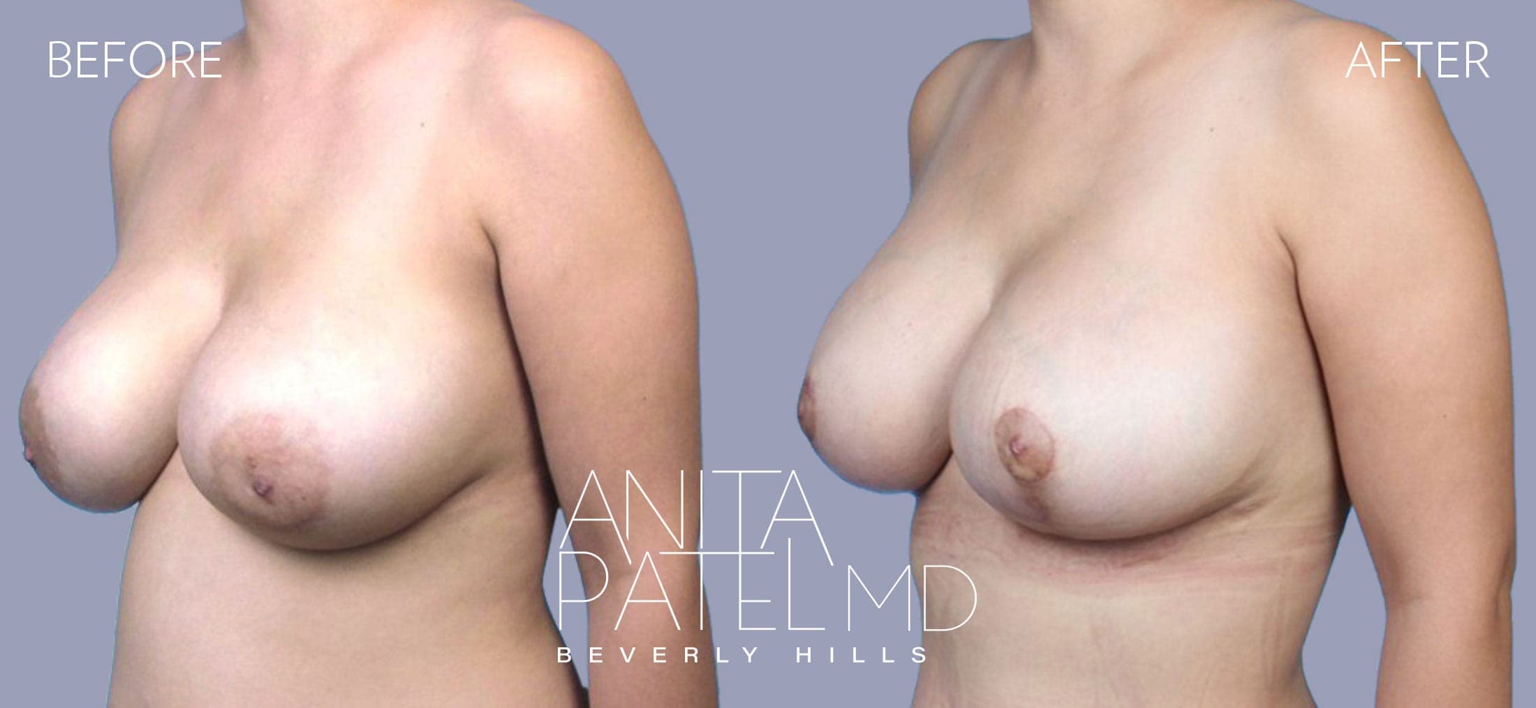 Breast Lift before and after — Patient 6, photo 4 of 5 — Dr. Anita Patel, MD, FACS, Beverly Hills