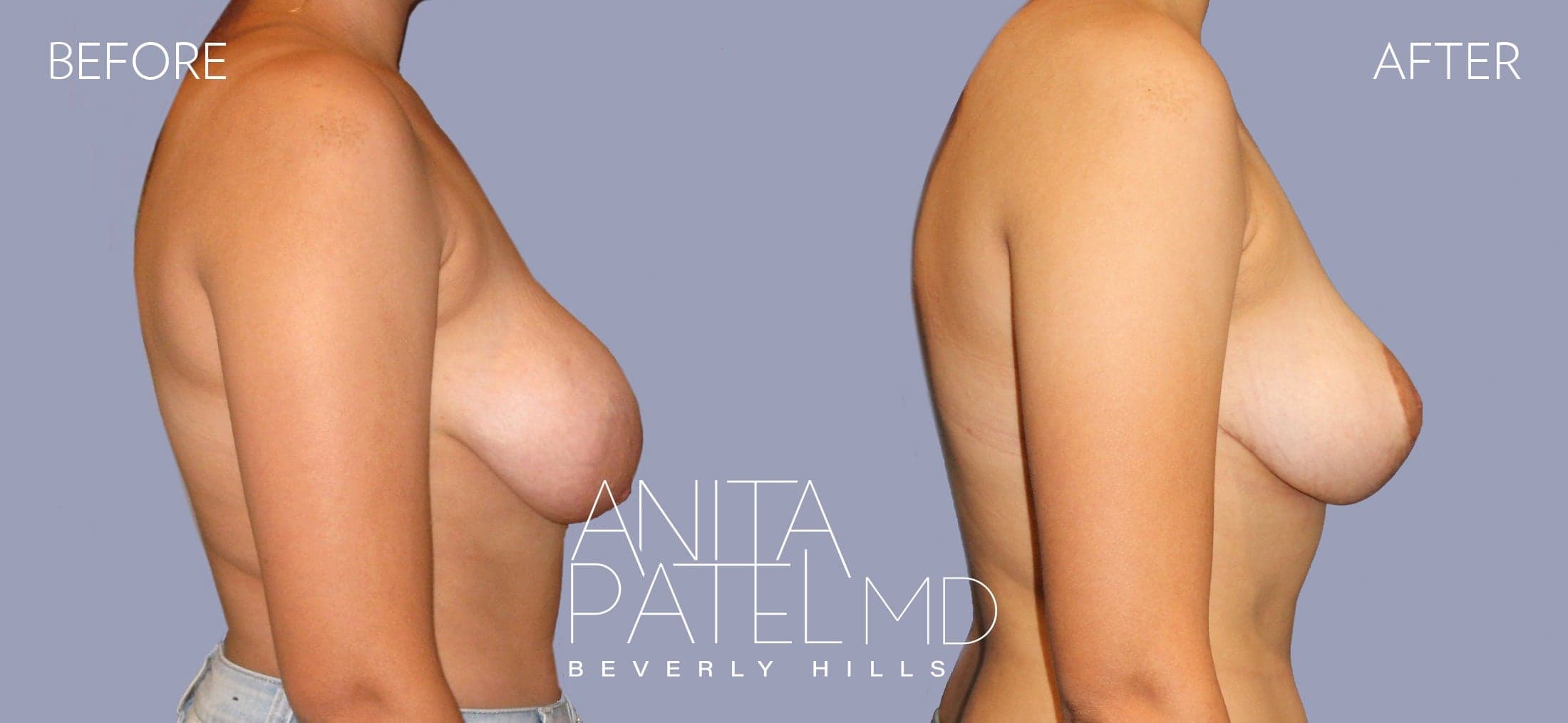 Breast Reduction before and after — Patient 9, photo 4 of 4 — Dr. Anita Patel, MD, FACS, Beverly Hills